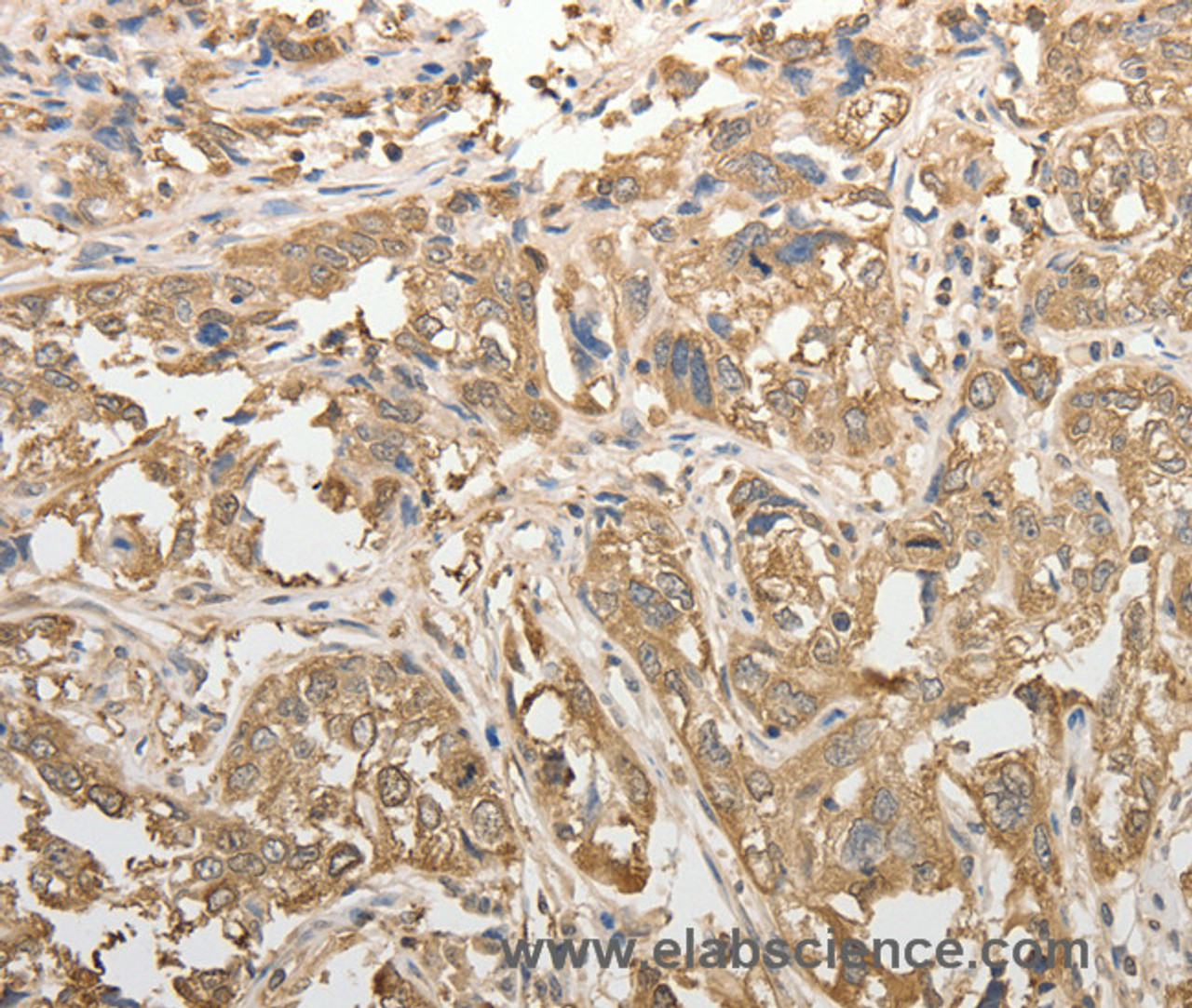 Immunohistochemistry of paraffin-embedded Human esophagus cancer tissue using ADHFE1 Polyclonal Antibody at dilution 1:50