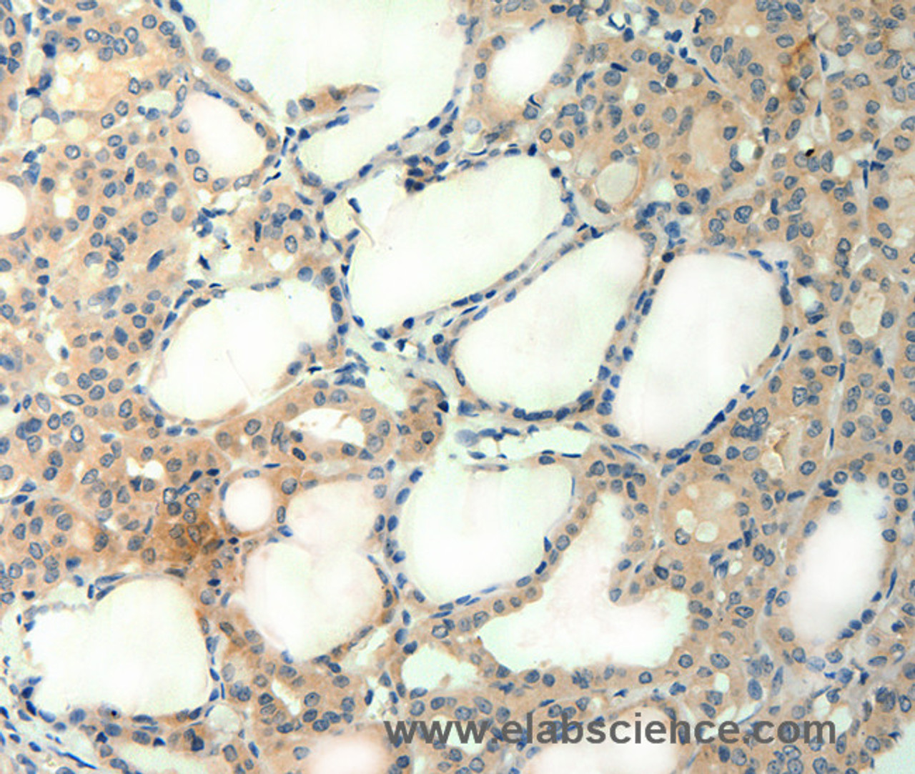 Immunohistochemistry of paraffin-embedded Human thyroid cancer tissue using AGRN Polyclonal Antibody at dilution of 1:50