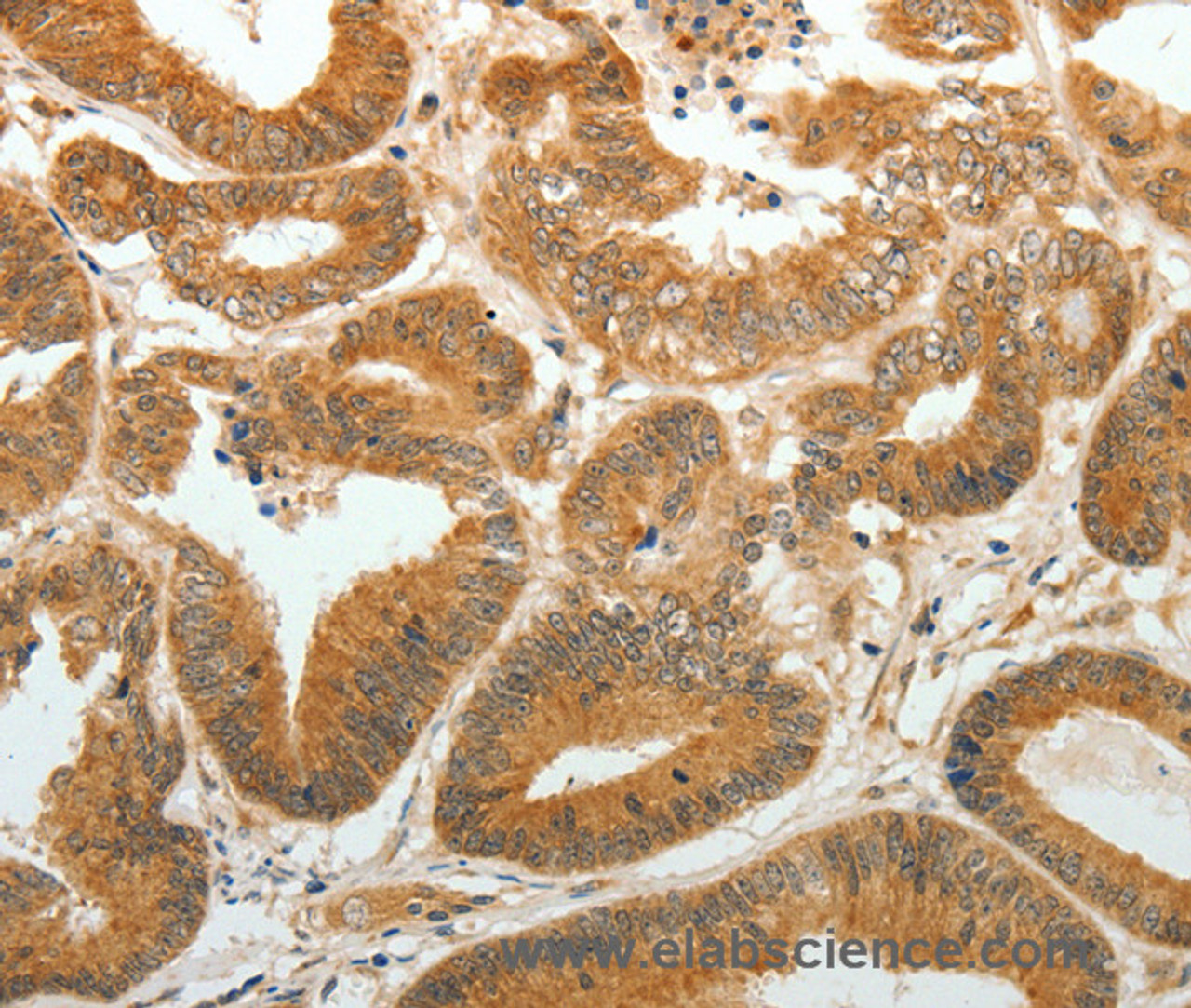 Immunohistochemistry of paraffin-embedded Human colon cancer using AKR1C1 Polyclonal Antibody at dilution of 1:30