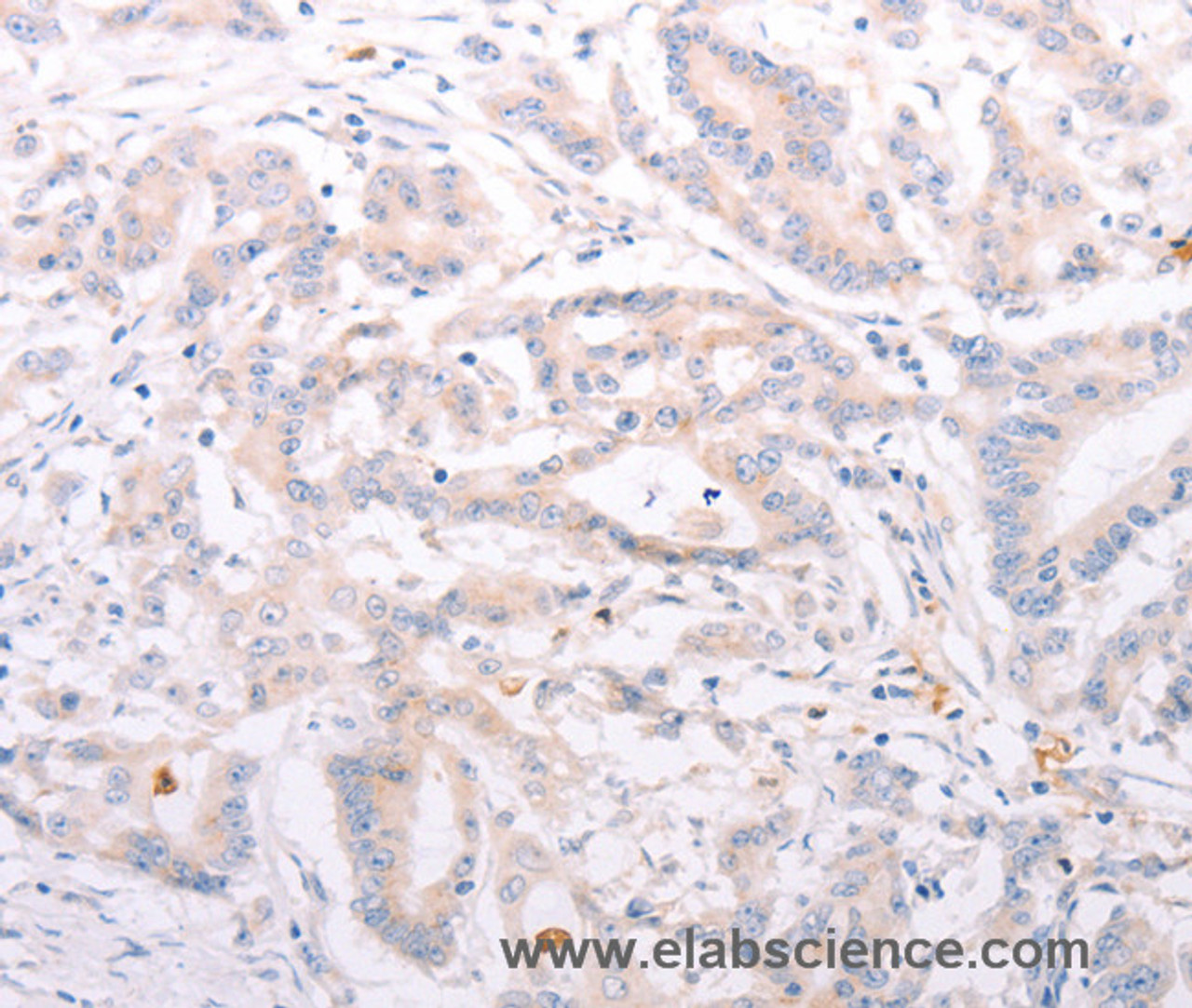Immunohistochemistry of paraffin-embedded Human colon cancer tissue using ANKRA2 Polyclonal Antibody at dilution 1:50