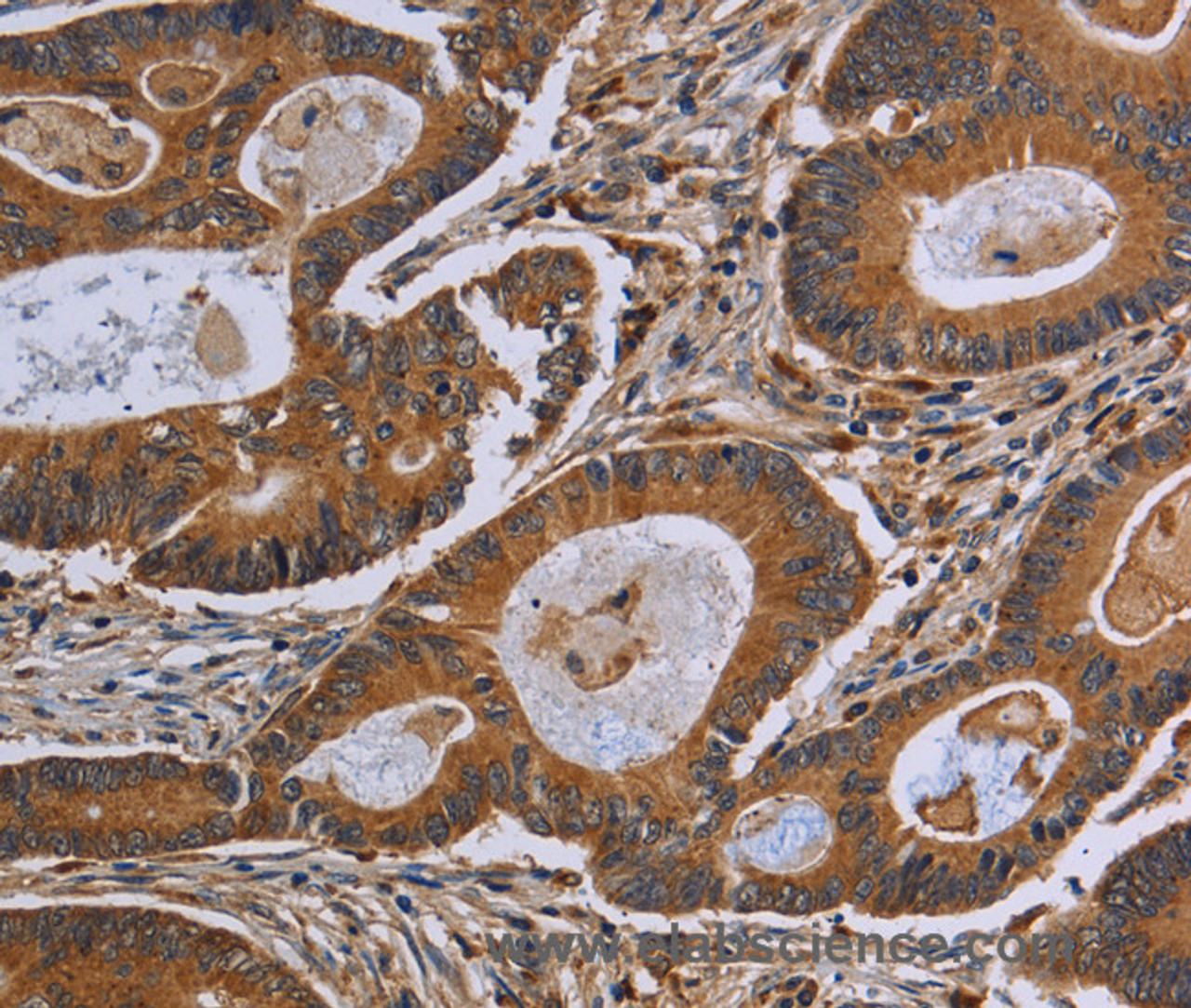 Immunohistochemistry of paraffin-embedded Human colon cancer using GJB4 Polyclonal Antibody at dilution of 1:40