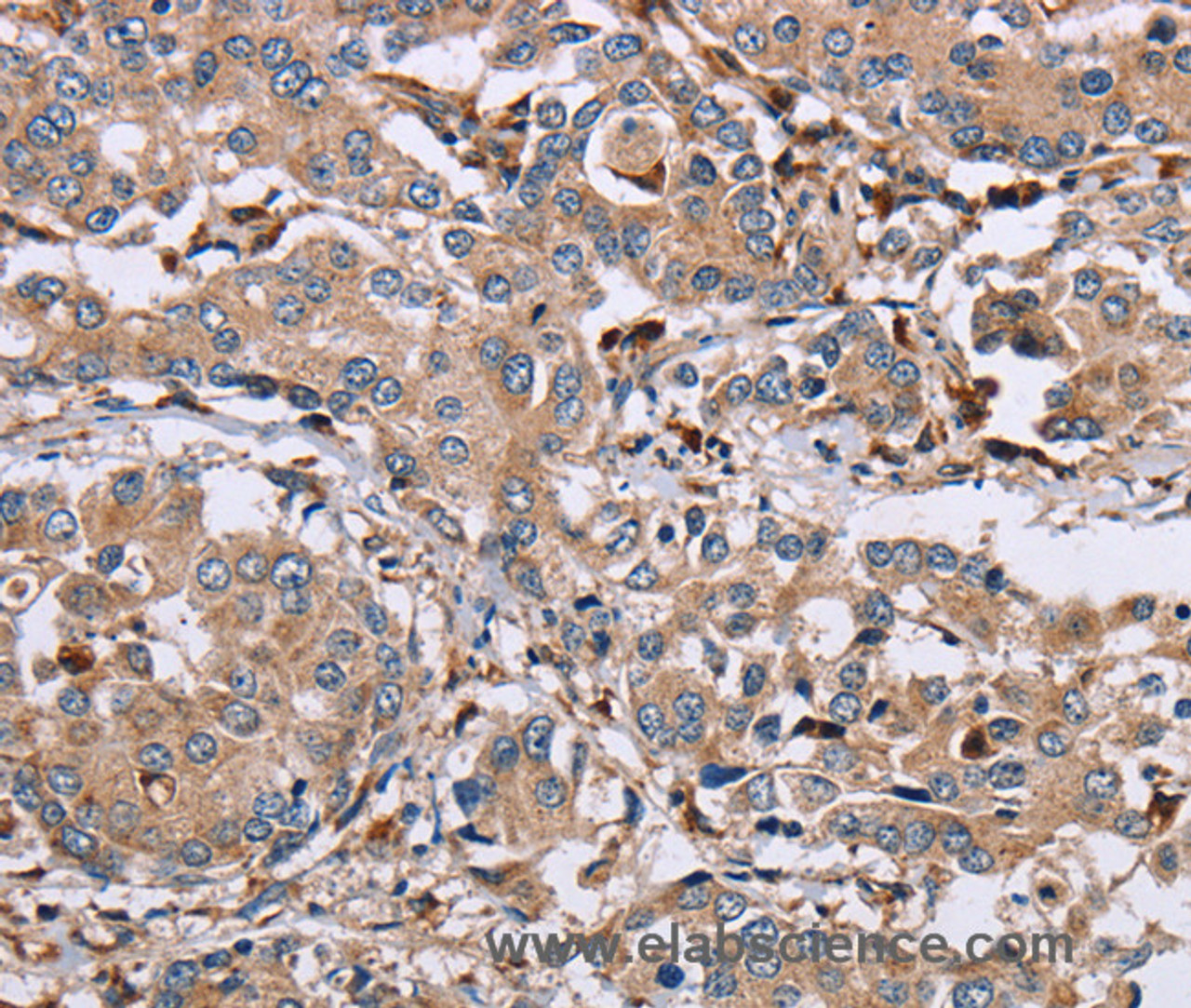 Immunohistochemistry of paraffin-embedded Human liver cancer using MAGEA3 Polyclonal Antibody at dilution of 1:50