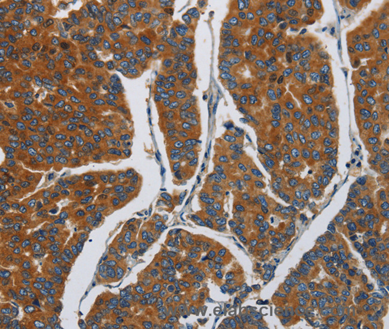 Immunohistochemistry of paraffin-embedded Human breast cancer using APEH  Polyclonal Antibody at dilution of 1:30