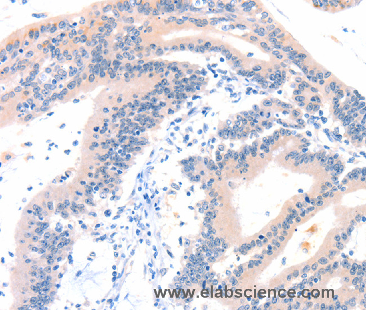 Immunohistochemistry of paraffin-embedded Human colon cancer tissue using ITGA6 Polyclonal Antibody at dilution 1:50