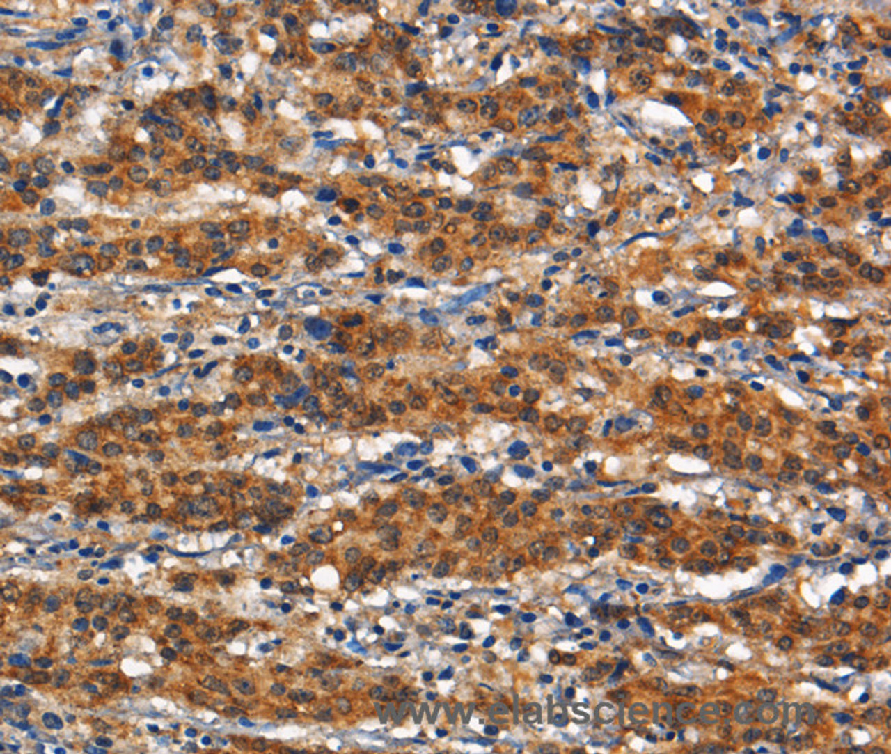 Immunohistochemistry of paraffin-embedded Human gasrtic cancer tissue using CD13 Polyclonal Antibody at dilution 1:80