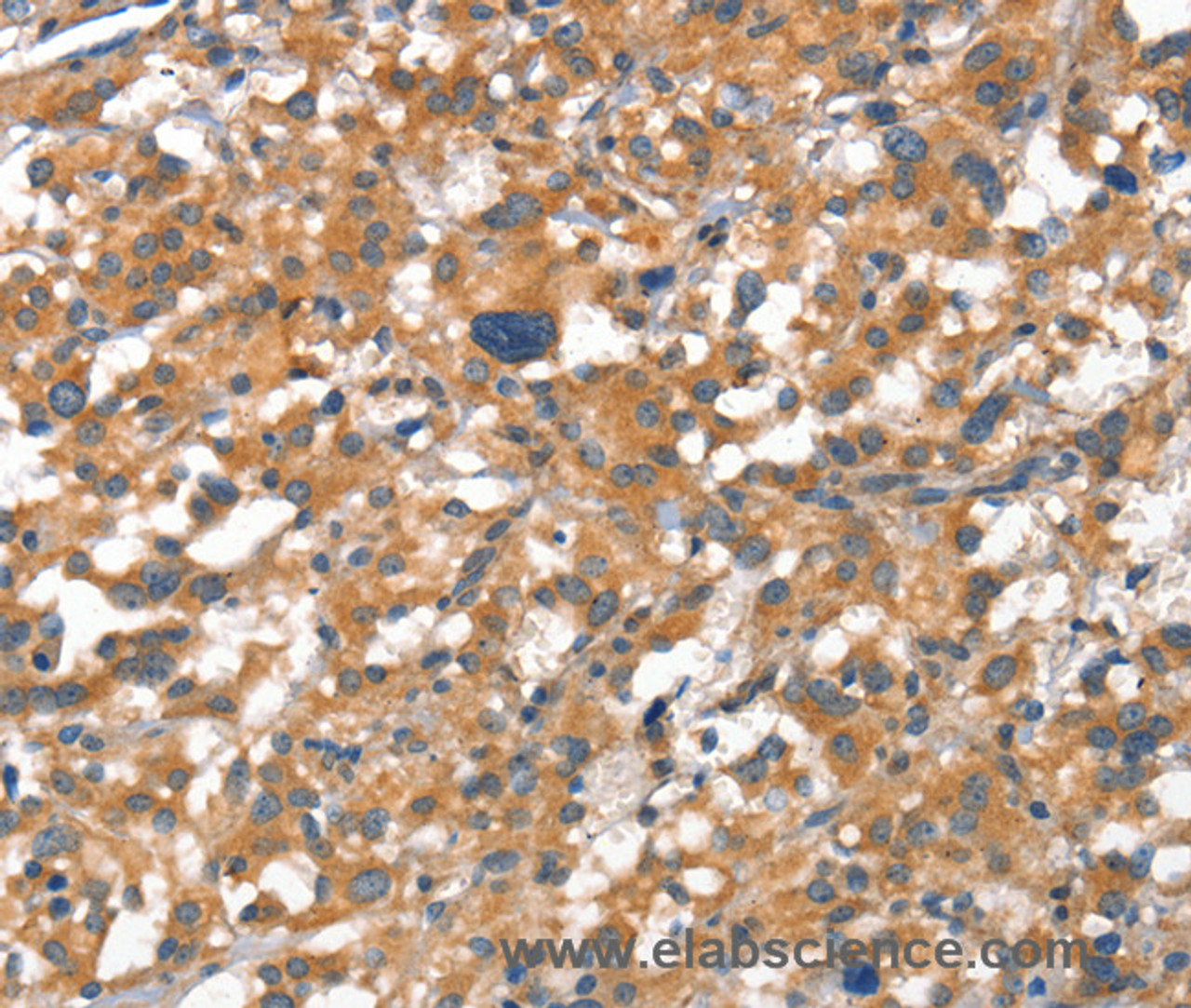 Immunohistochemistry of paraffin-embedded Human thyroid cancer tissue using VE-Cadherin Polyclonal Antibody at dilution 1:50