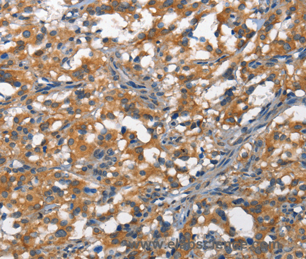 Immunohistochemistry of paraffin-embedded Human thyroid cancer tissue using DDR2 Polyclonal Antibody at dilution 1:40