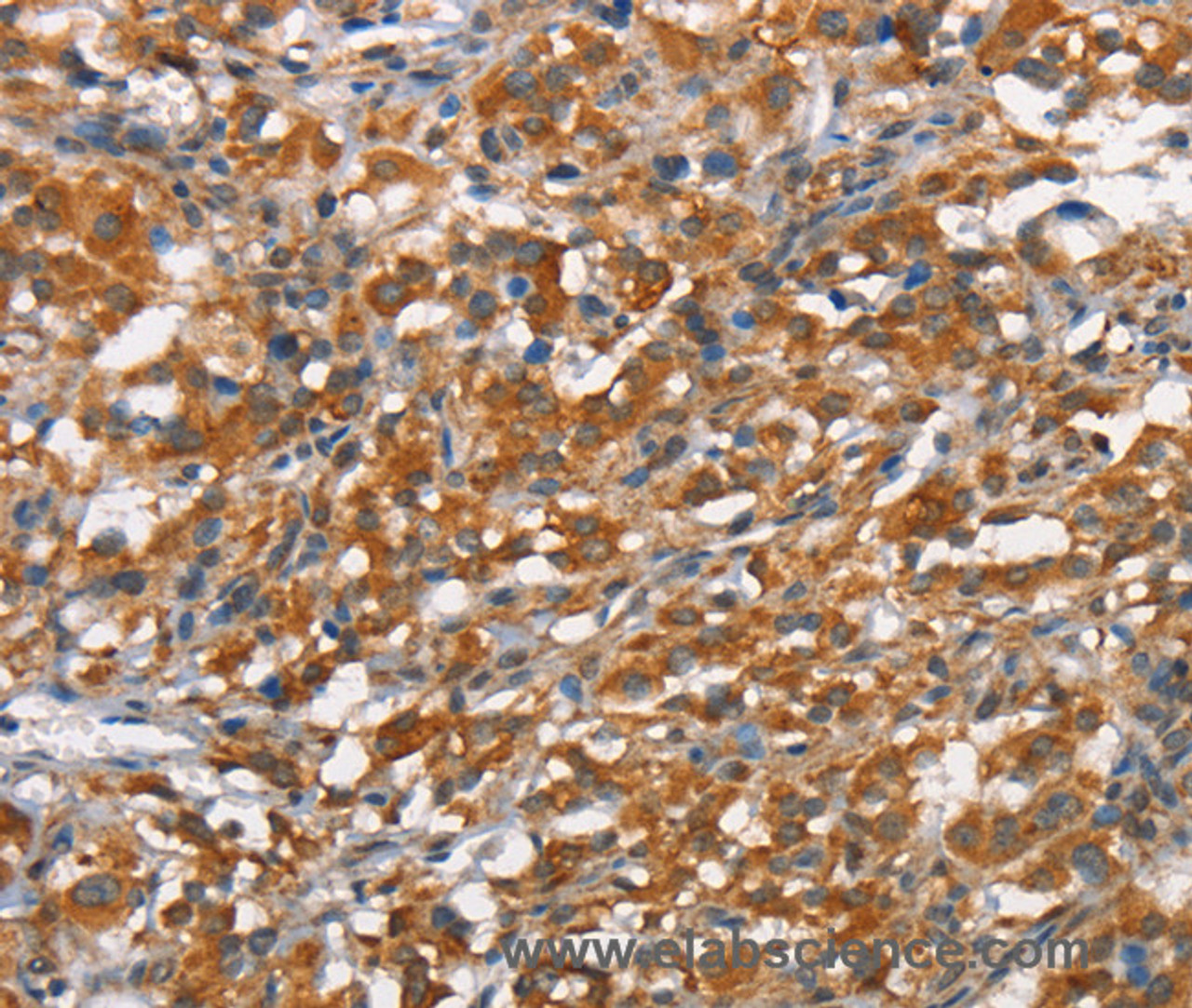 Immunohistochemistry of paraffin-embedded Human thyroid cancer tissue using CD168 Polyclonal Antibody at dilution 1:40