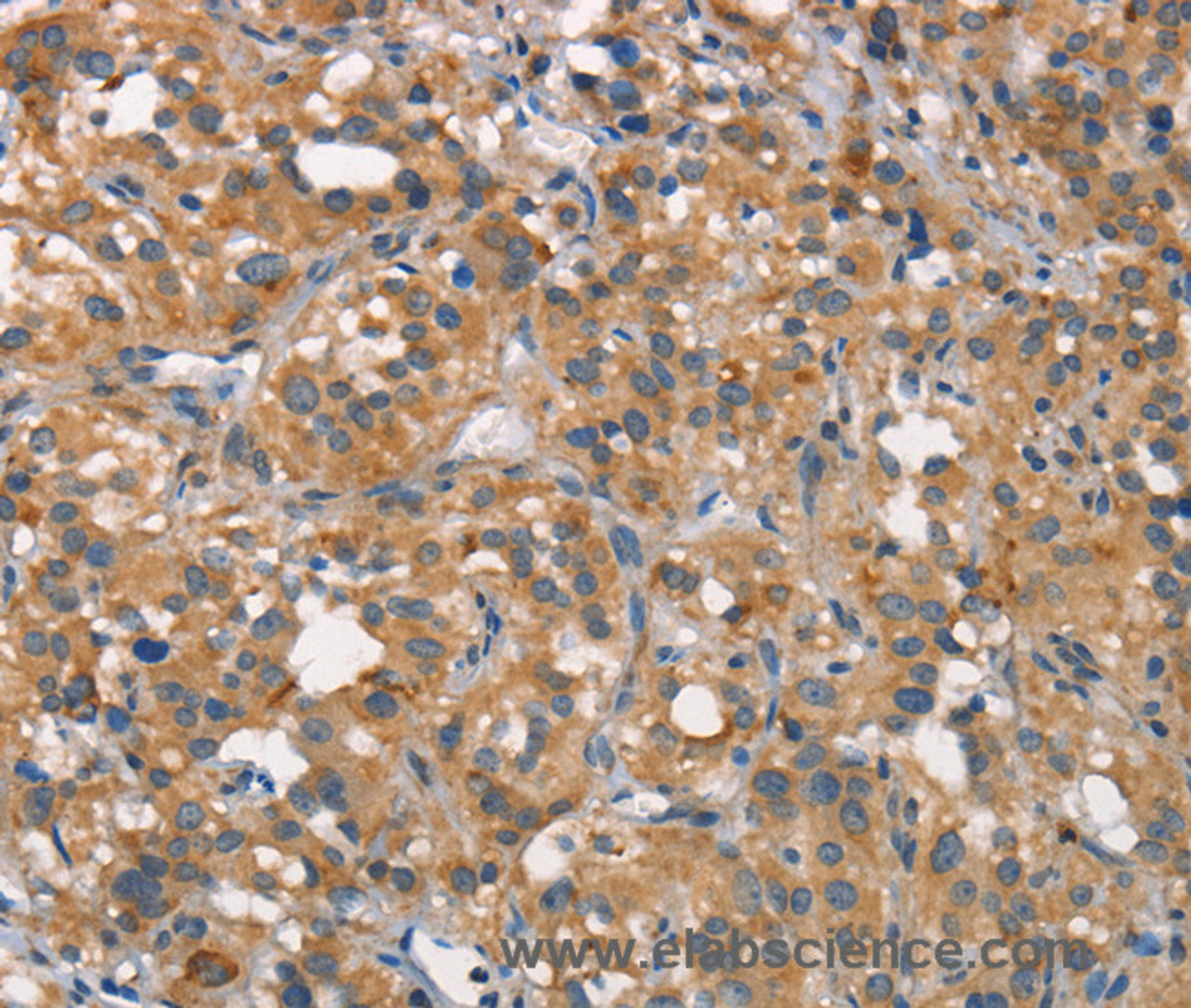 Immunohistochemistry of paraffin-embedded Human thyroid cancer tissue using CEACAM6 Polyclonal Antibody at dilution 1:50