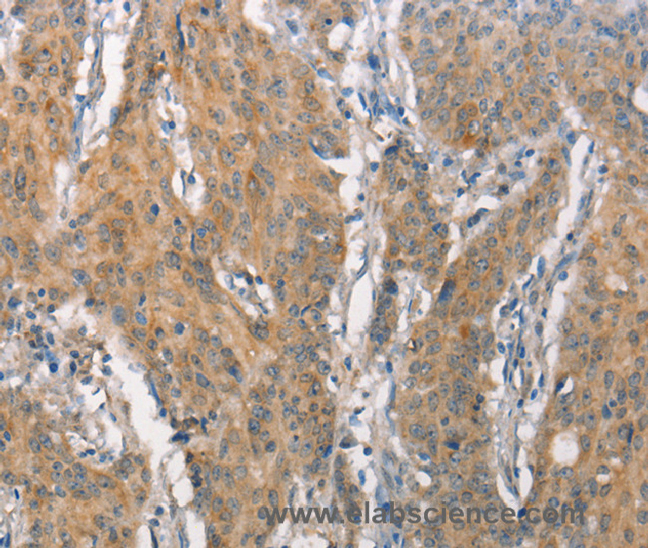 Immunohistochemistry of paraffin-embedded Human gastric cancer tissue using CEACAM6 Polyclonal Antibody at dilution 1:50