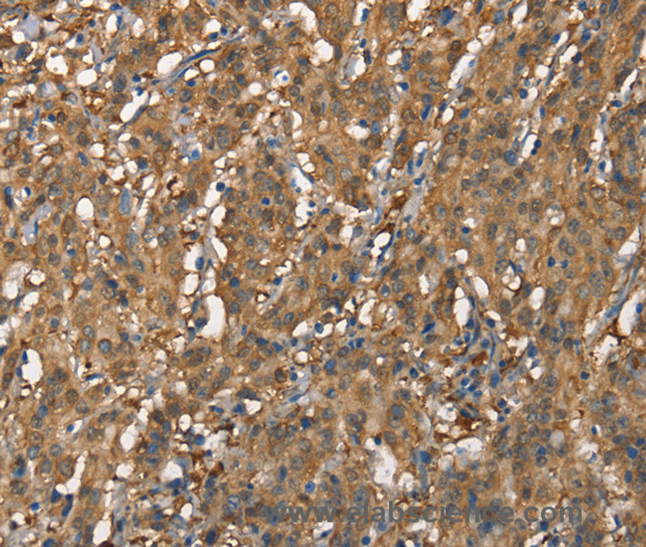 Immunohistochemistry of paraffin-embedded Human gastric cancer tissue using CDC25A Polyclonal Antibody at dilution 1:60