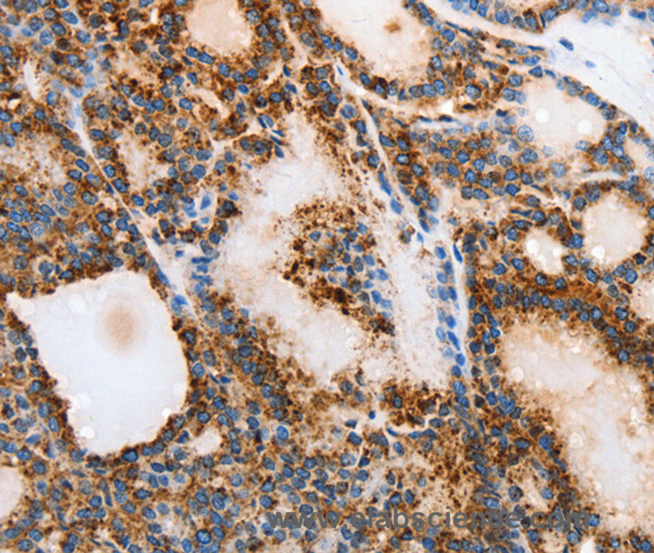 Immunohistochemistry of paraffin-embedded Human thyroid cancer tissue using MUC6 Polyclonal Antibody at dilution 1:40