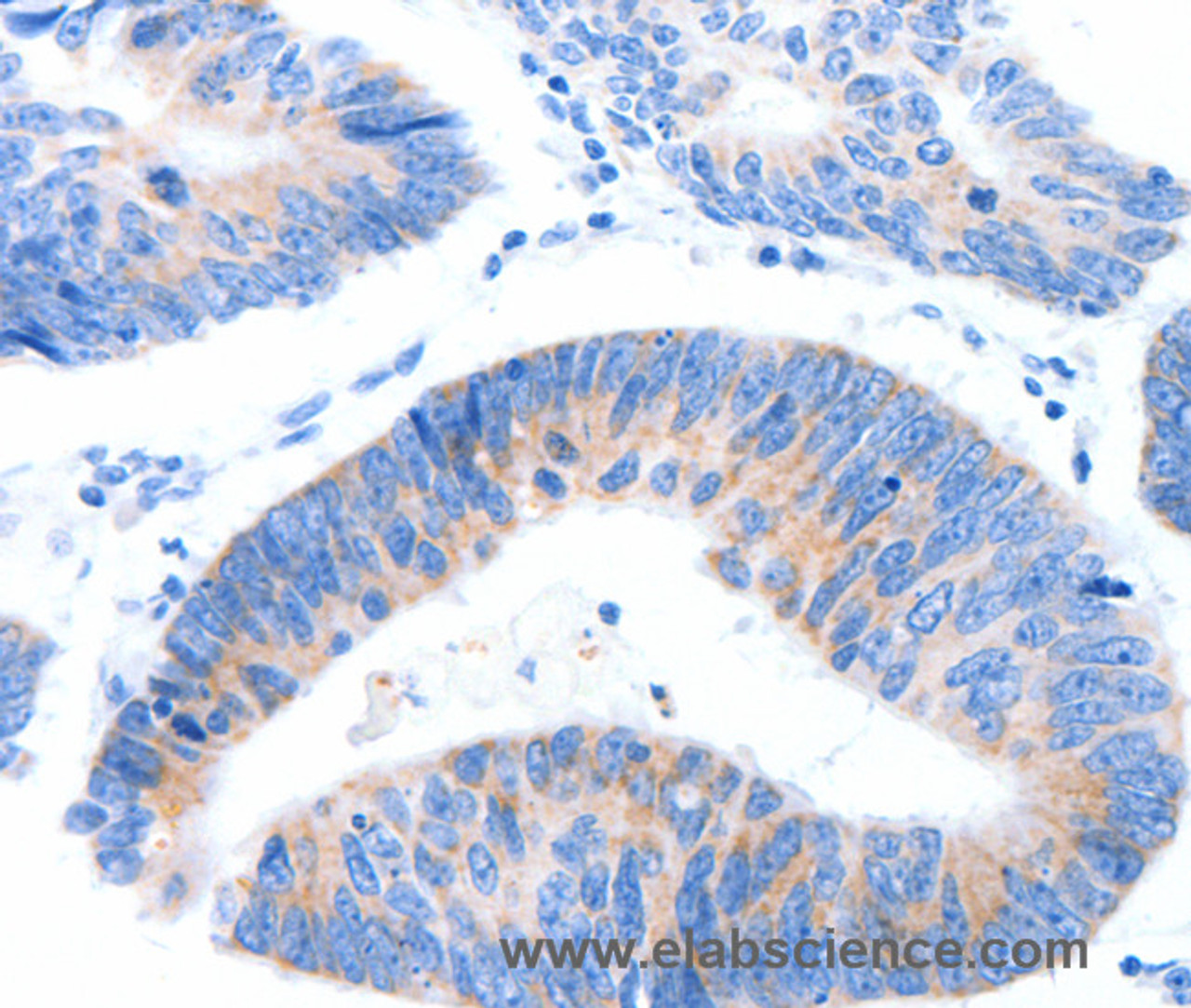 Immunohistochemistry of paraffin-embedded Human colon cancer tissue using MUC3A Polyclonal Antibody at dilution 1:60