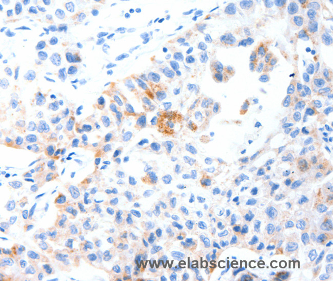Immunohistochemistry of paraffin-embedded Human lung cancer tissue using MUC3A Polyclonal Antibody at dilution 1:60