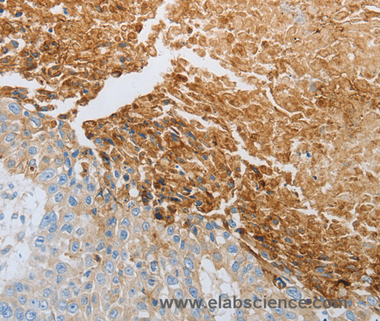 Immunohistochemistry of paraffin-embedded Human esophagus cancer tissue using RTN4 Polyclonal Antibody at dilution 1:40