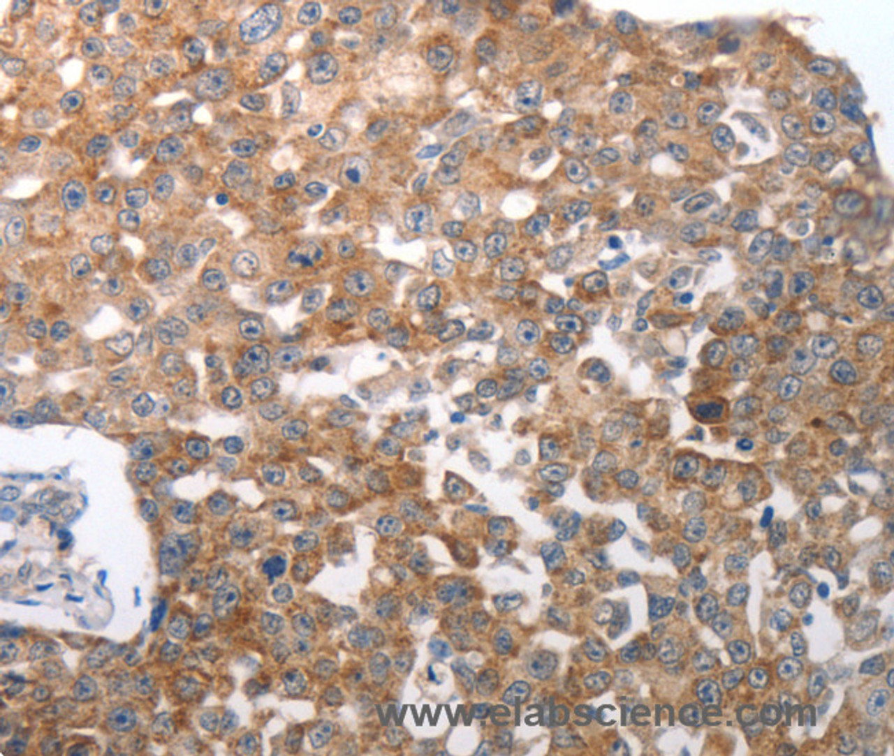 Immunohistochemistry of paraffin-embedded Human breast cancer using NQO2 Polyclonal Antibody at dilution of 1:50