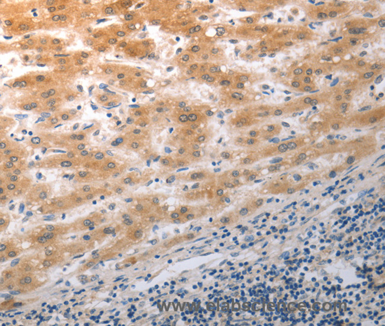 Immunohistochemistry of paraffin-embedded Human liver cancer using NQO2 Polyclonal Antibody at dilution of 1:50