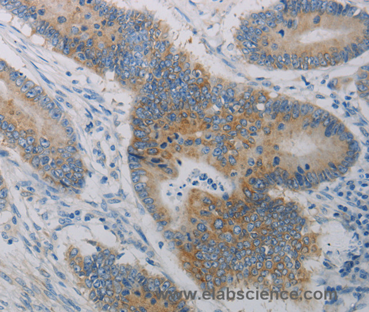 Immunohistochemistry of paraffin-embedded Human colon cancer tissue using CD303 Polyclonal Antibody at dilution of 1:50