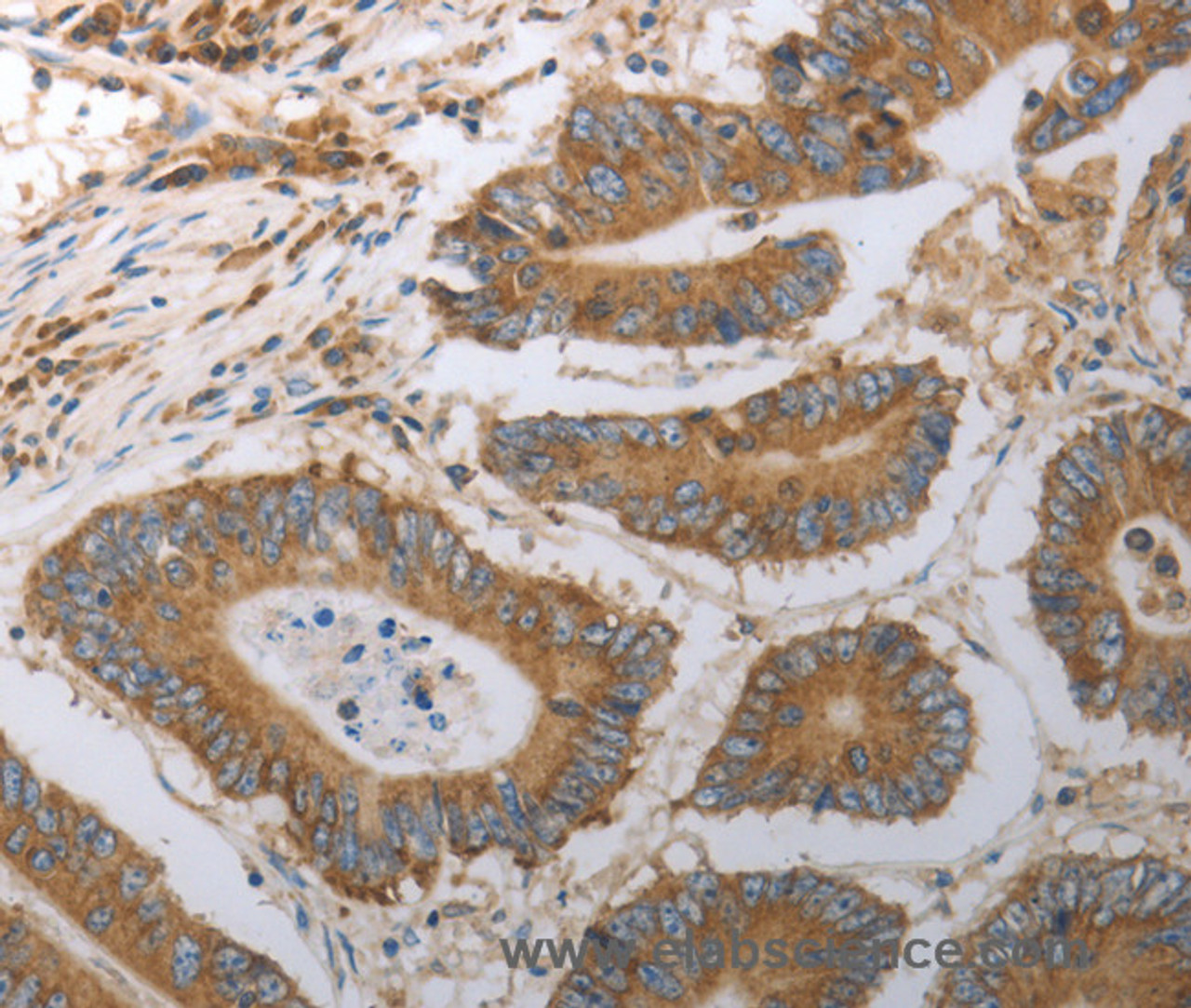 Immunohistochemistry of paraffin-embedded Human colon cancer using SLC22A6 Polyclonal Antibody at dilution of 1:40