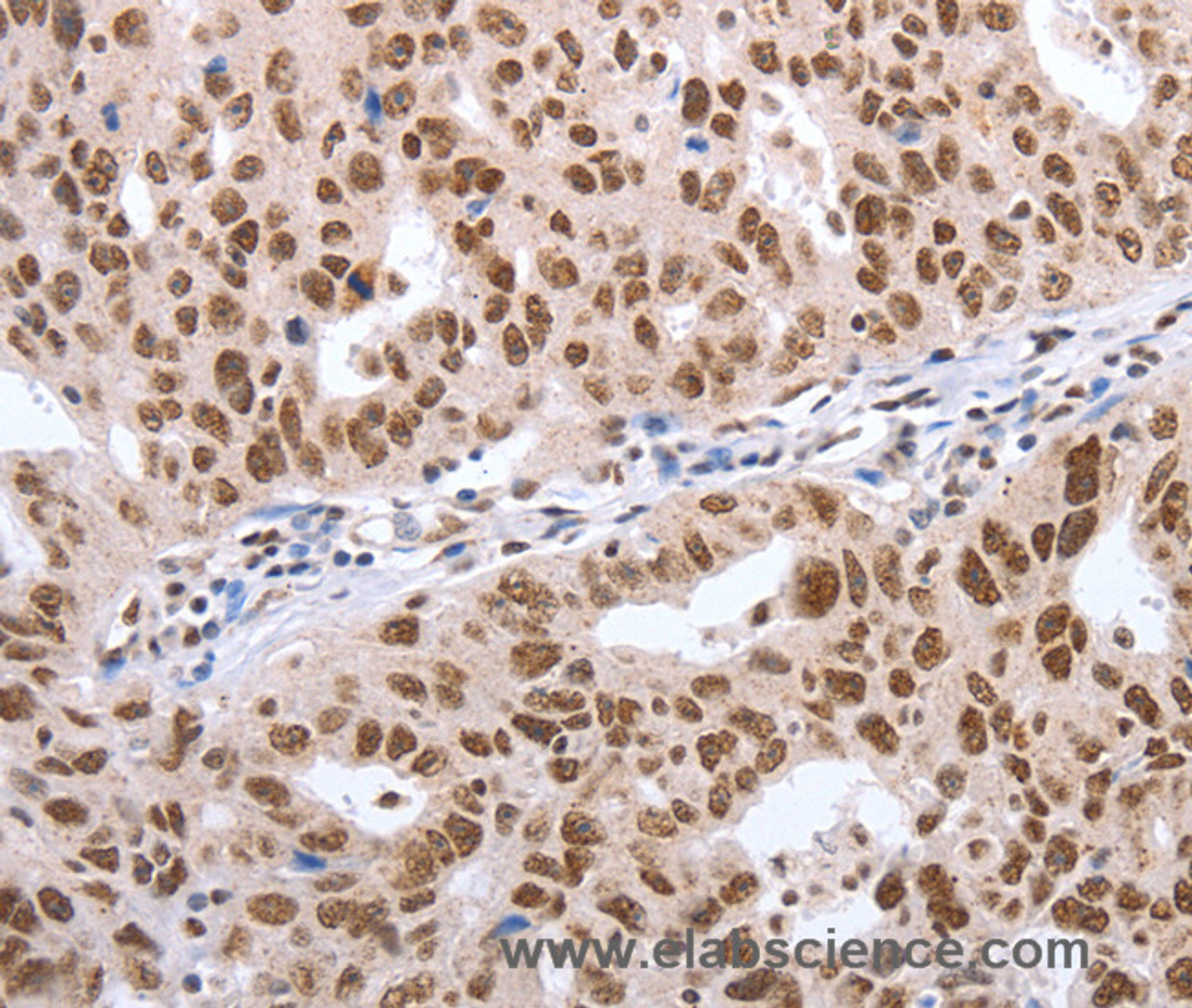 Immunohistochemistry of paraffin-embedded Human ovarian cancer tissue using Oct-6 Polyclonal Antibody at dilution 1:40