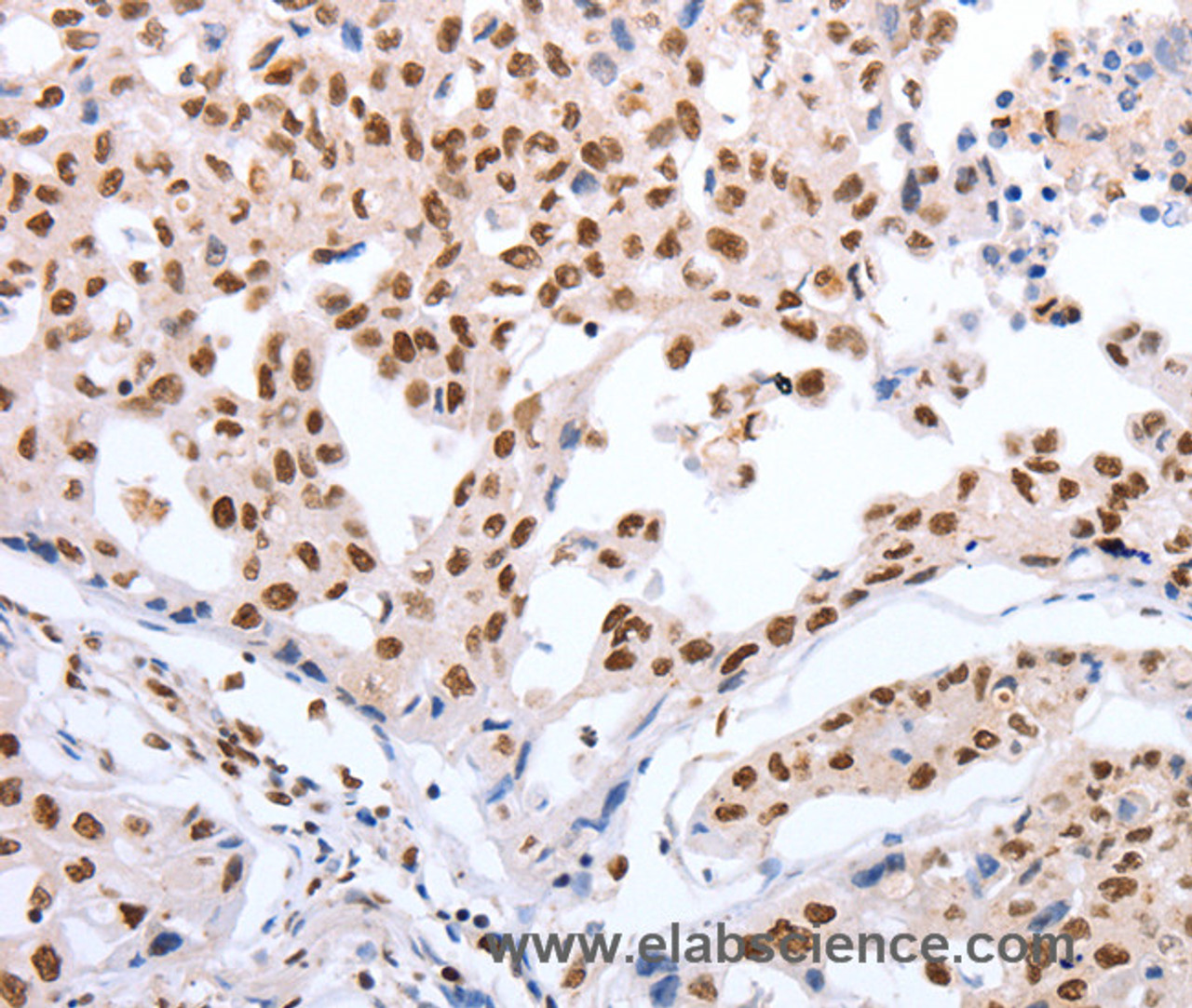 Immunohistochemistry of paraffin-embedded Human lung cancer tissue using Oct-6 Polyclonal Antibody at dilution 1:40