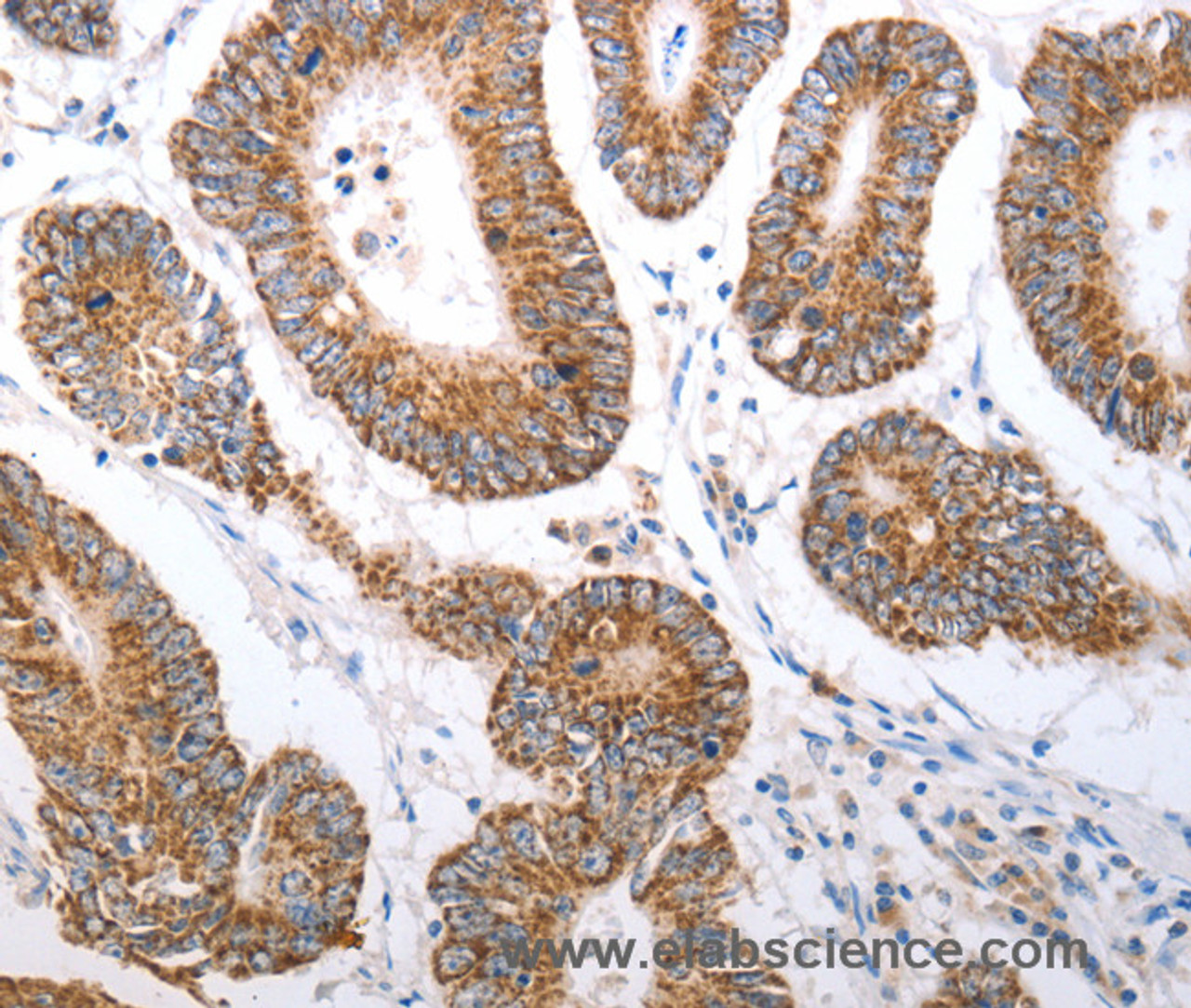 Immunohistochemistry of paraffin-embedded Human colon cancer tissue using HCRTR1 Polyclonal Antibody at dilution 1:70