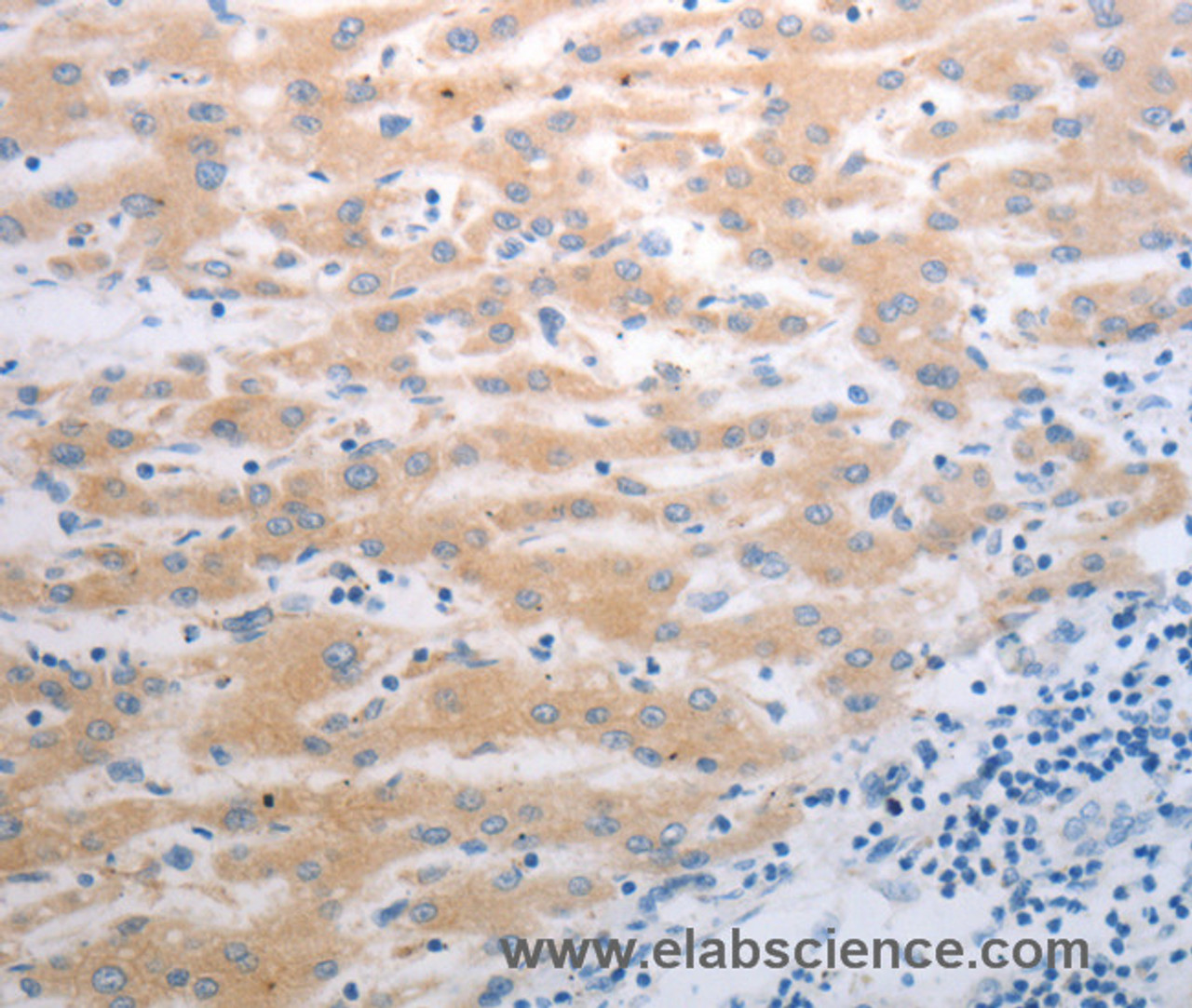 Immunohistochemistry of paraffin-embedded Human liver cancer using PAK1 Polyclonal Antibody at dilution of 1:40