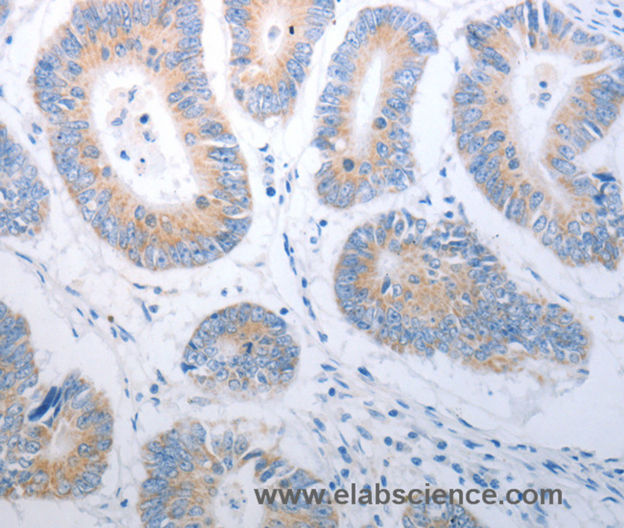 Immunohistochemistry of paraffin-embedded Human colon cancer using PAK1 Polyclonal Antibody at dilution of 1:40