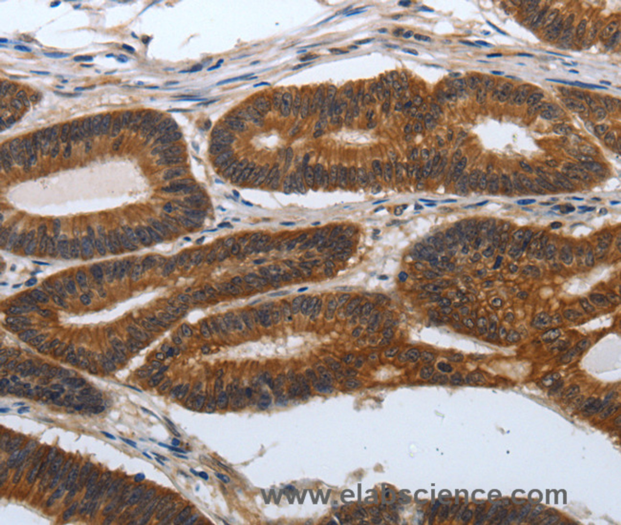 Immunohistochemistry of paraffin-embedded Human colon cancer tissue using PDCD7 Polyclonal Antibody at dilution 1:60