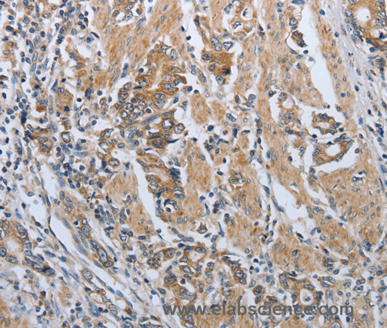 Immunohistochemistry of paraffin-embedded Human gasrtic cancer tissue using PD-1/CD279 Polyclonal Antibody at dilution 1:50