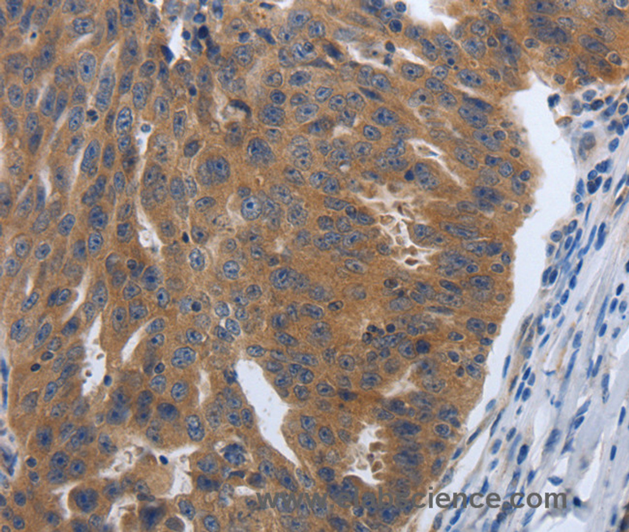 Immunohistochemistry of paraffin-embedded Human ovarian cancer tissue using PDGFA Polyclonal Antibody at dilution 1:70