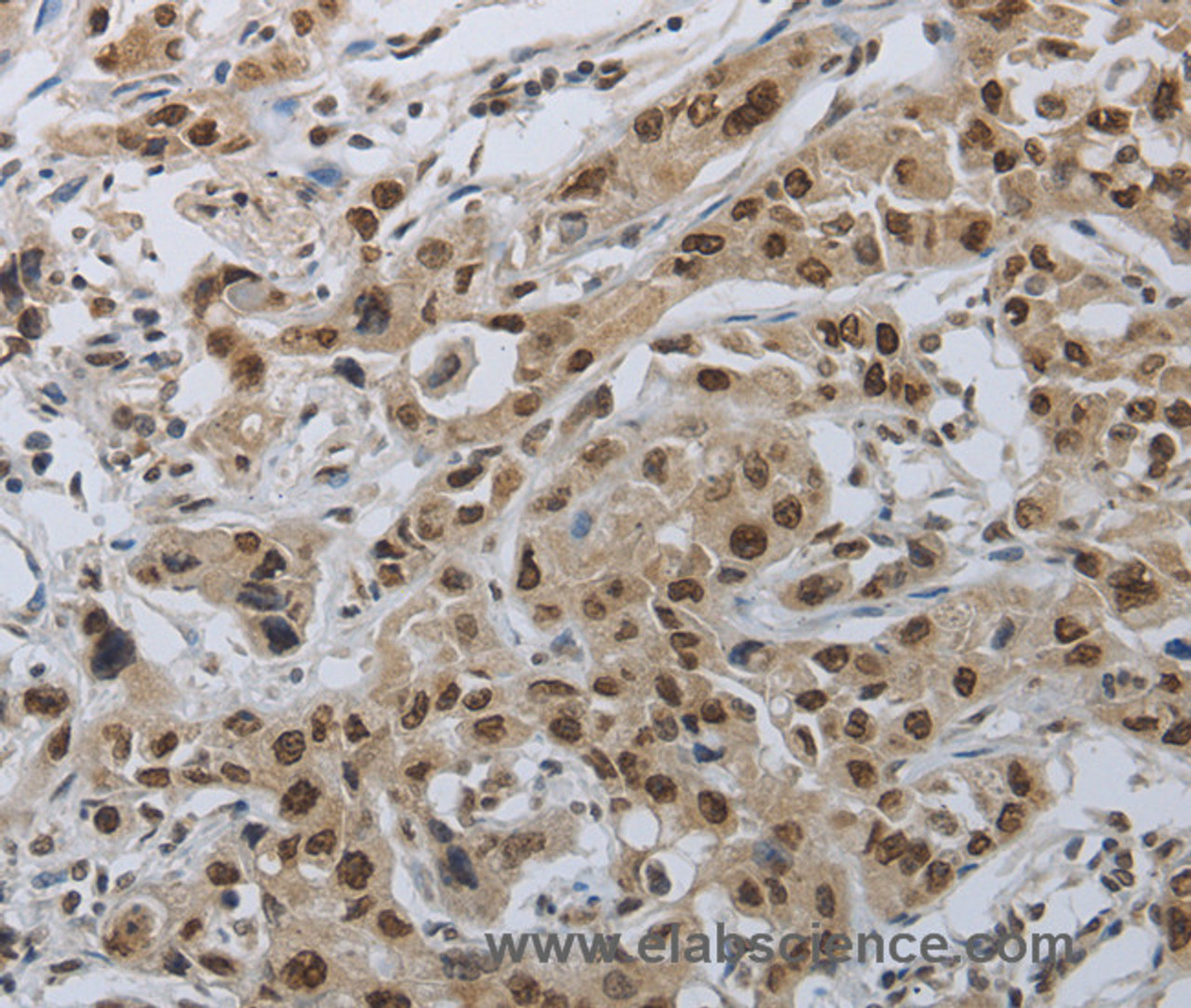 Immunohistochemistry of paraffin-embedded Human lung cancer using PRKAR1B Polyclonal Antibody at dilution of 1:70