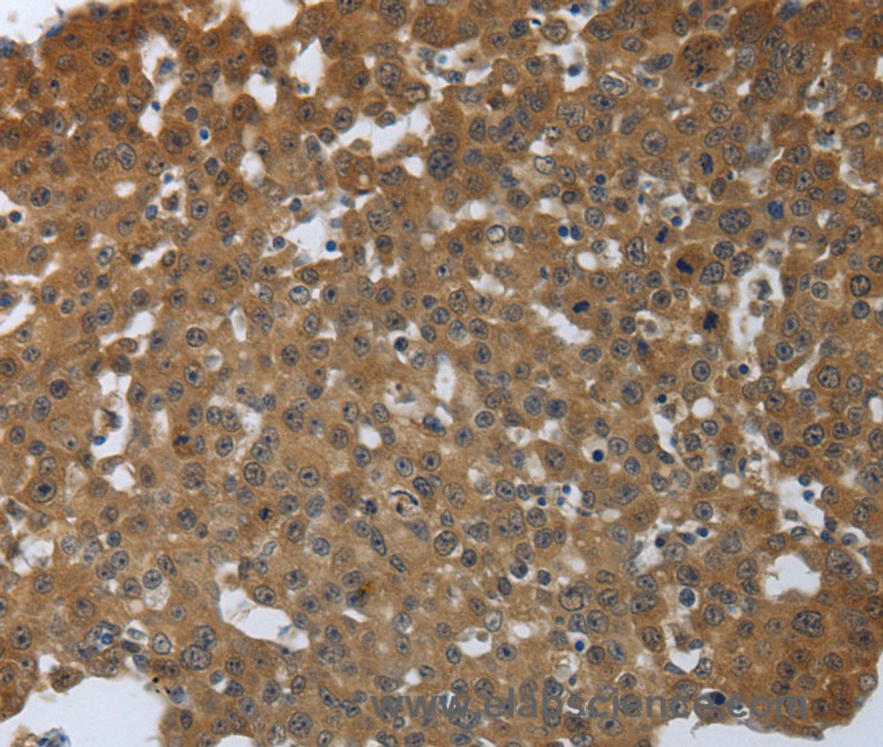 Immunohistochemistry of paraffin-embedded Human breast cancer tissue using PTPRM Polyclonal Antibody at dilution 1:40