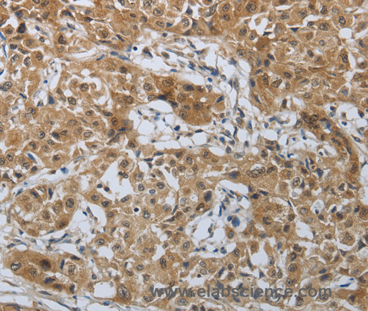 Immunohistochemistry of paraffin-embedded Human lung cancer tissue using PTPRM Polyclonal Antibody at dilution 1:40