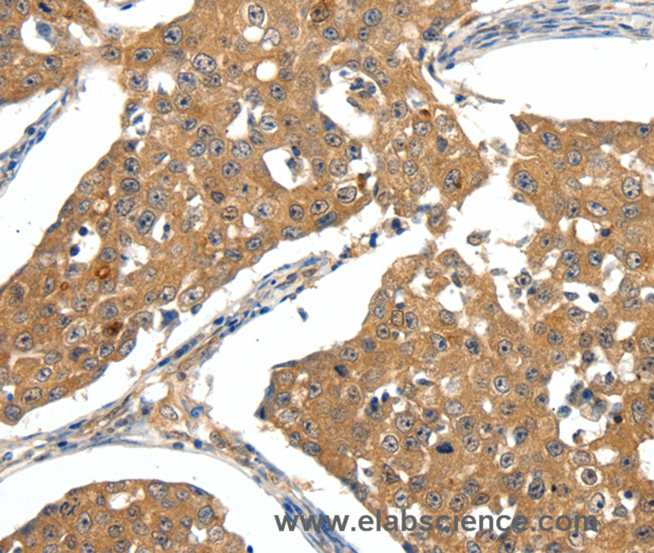 Immunohistochemistry of paraffin-embedded Human breast cancer tissue using SCN5A Polyclonal Antibody at dilution 1:30