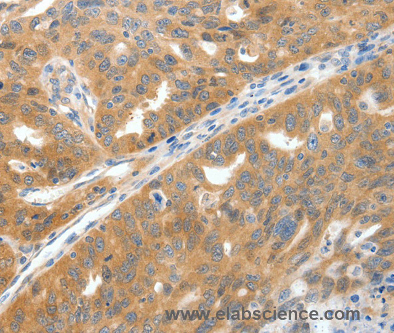Immunohistochemistry of paraffin-embedded Human ovarian cancer tissue using SCN9A Polyclonal Antibody at dilution 1:40