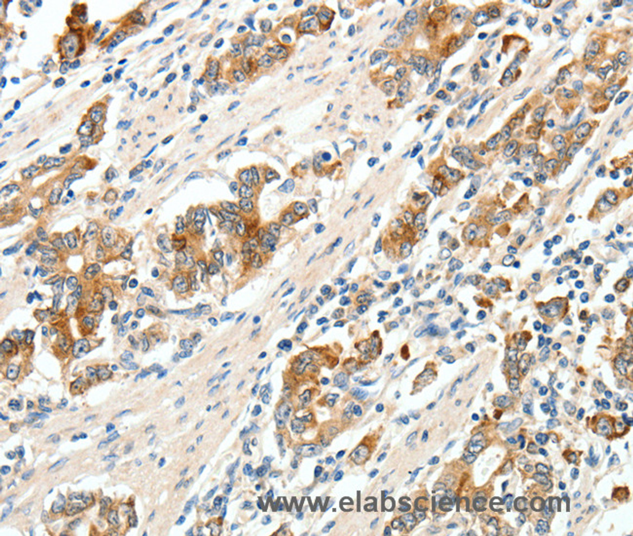 Immunohistochemistry of paraffin-embedded Human gastric cancer tissue using SCN9A Polyclonal Antibody at dilution 1:40