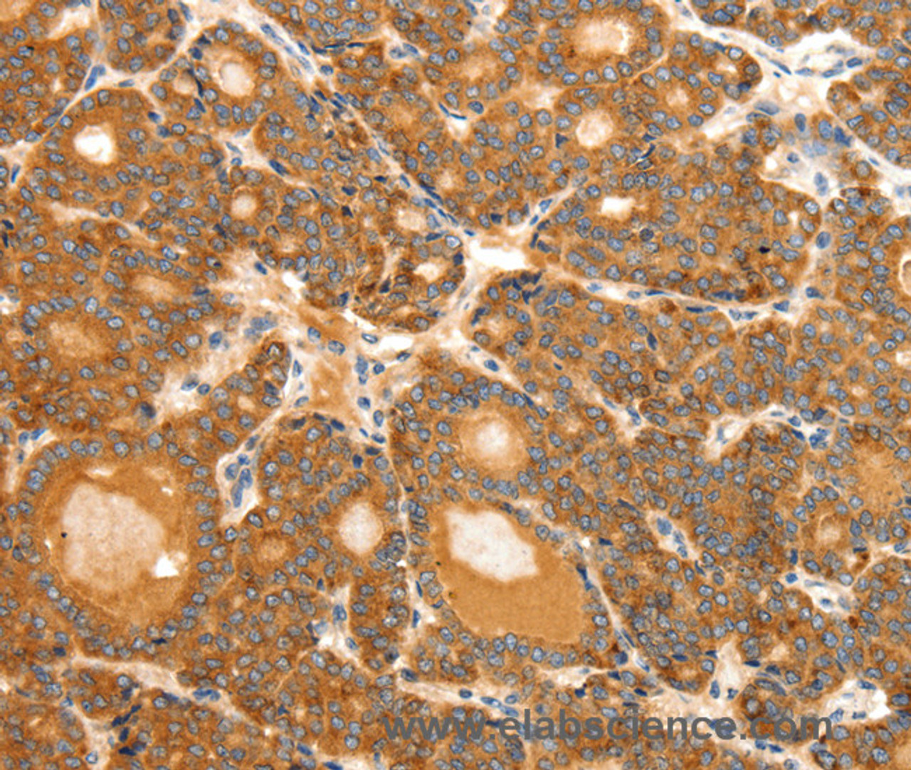 Immunohistochemistry of paraffin-embedded Human thyroid cancer tissue using SCT Polyclonal Antibody at dilution 1:40