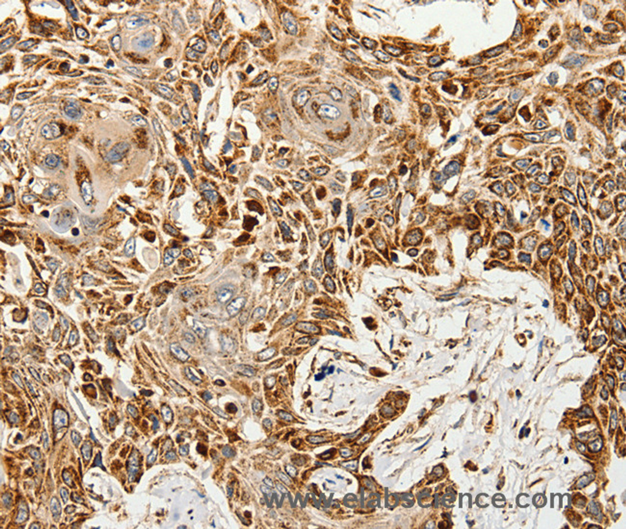 Immunohistochemistry of paraffin-embedded Human esophagus cancer tissue using SLC9A7 Polyclonal Antibody at dilution 1:60