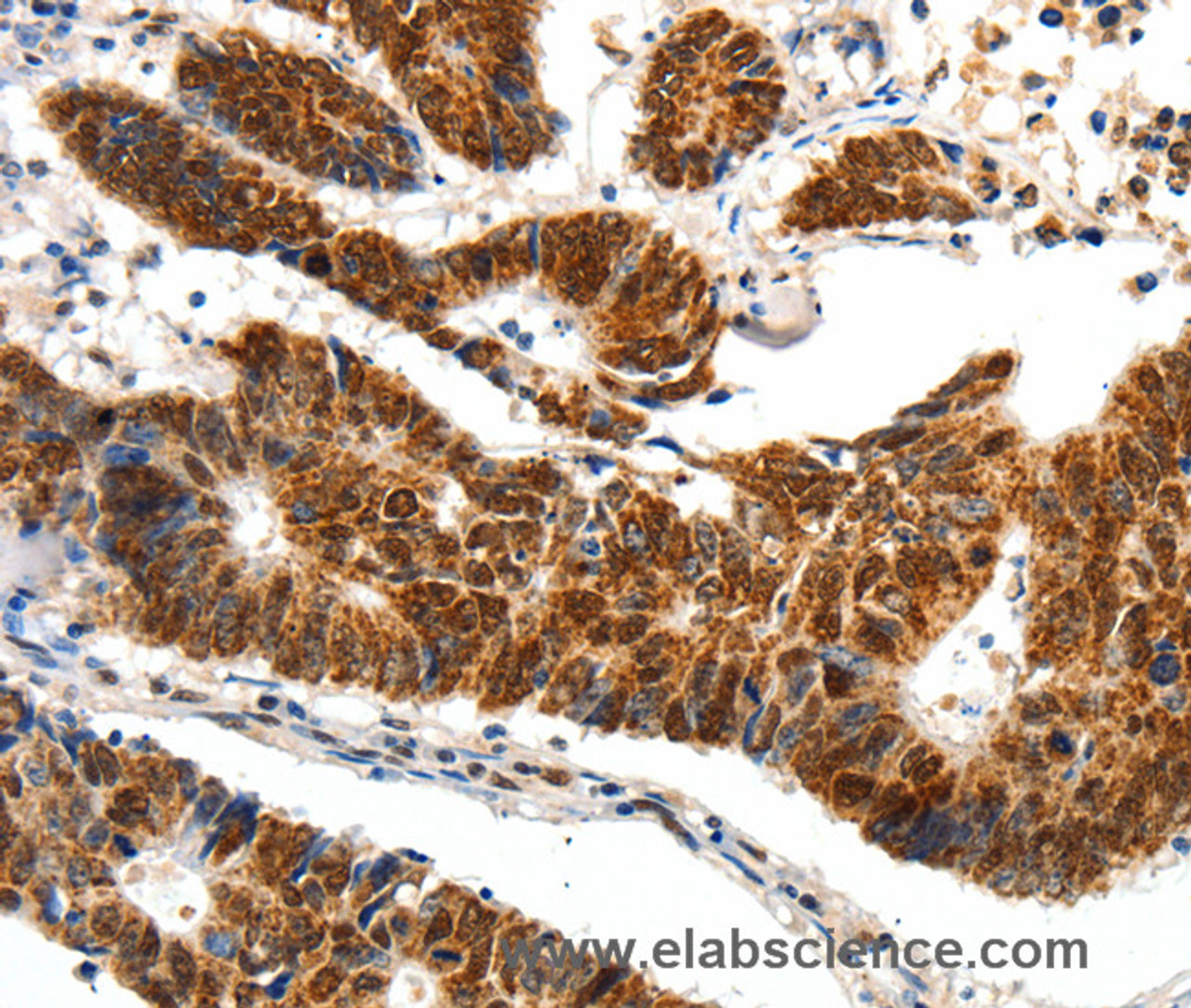 Immunohistochemistry of paraffin-embedded Human colon cancer tissue using SP1 Polyclonal Antibody at dilution 1:40