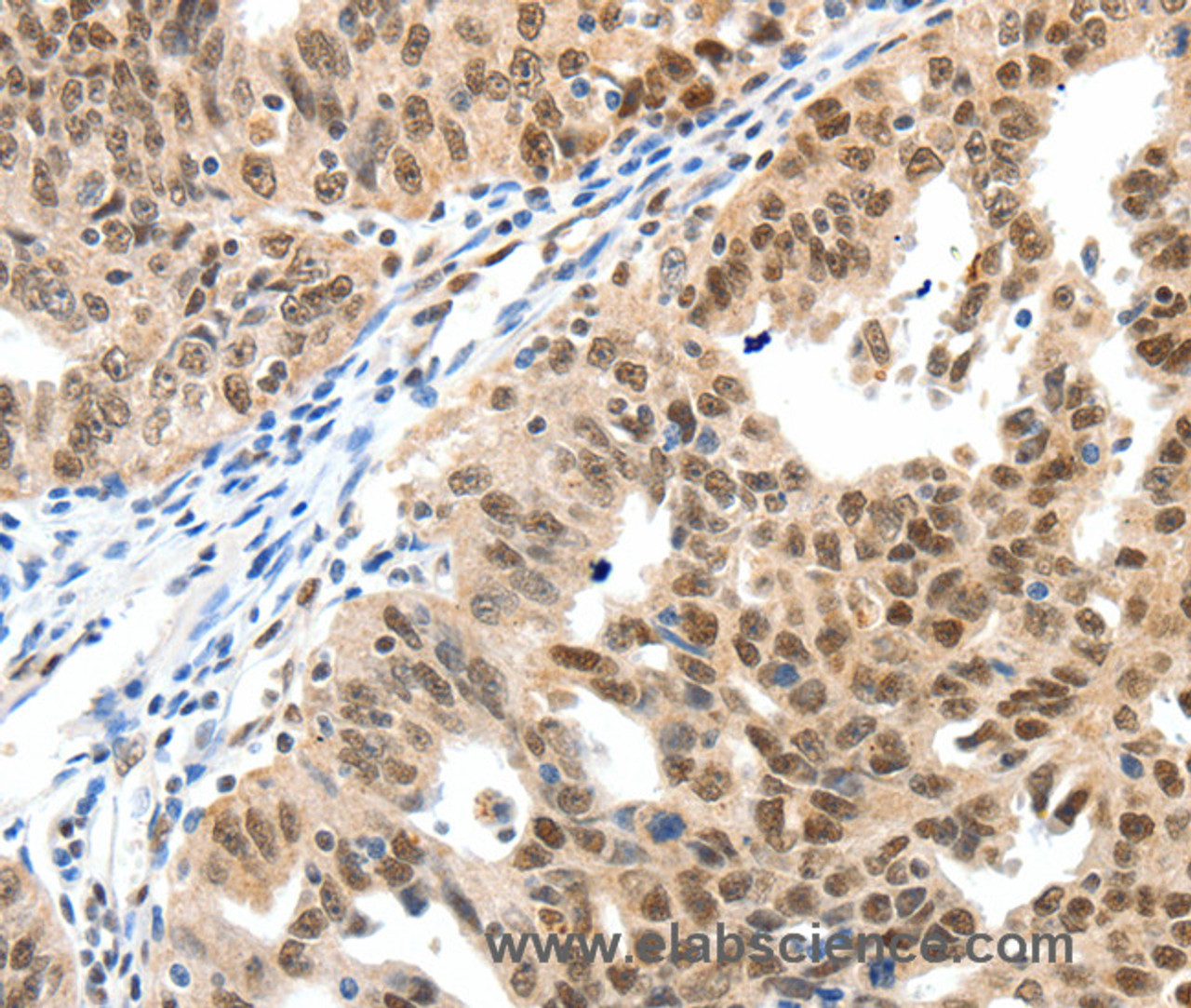 Immunohistochemistry of paraffin-embedded Human ovarian cancer tissue using SP1 Polyclonal Antibody at dilution 1:40