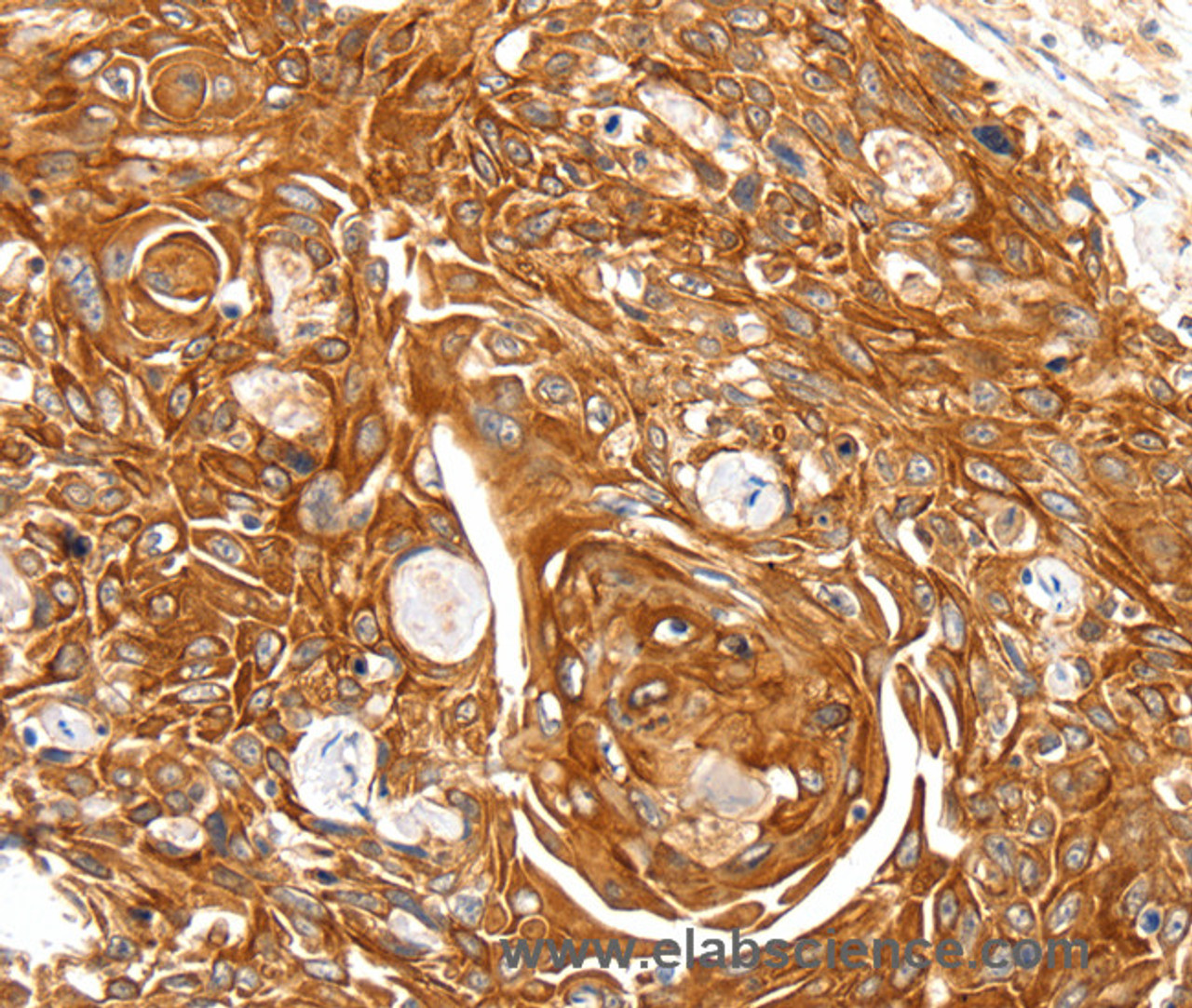 Immunohistochemistry of paraffin-embedded Human esophagus cancer using SFTPA1 Polyclonal Antibody at dilution of 1:30