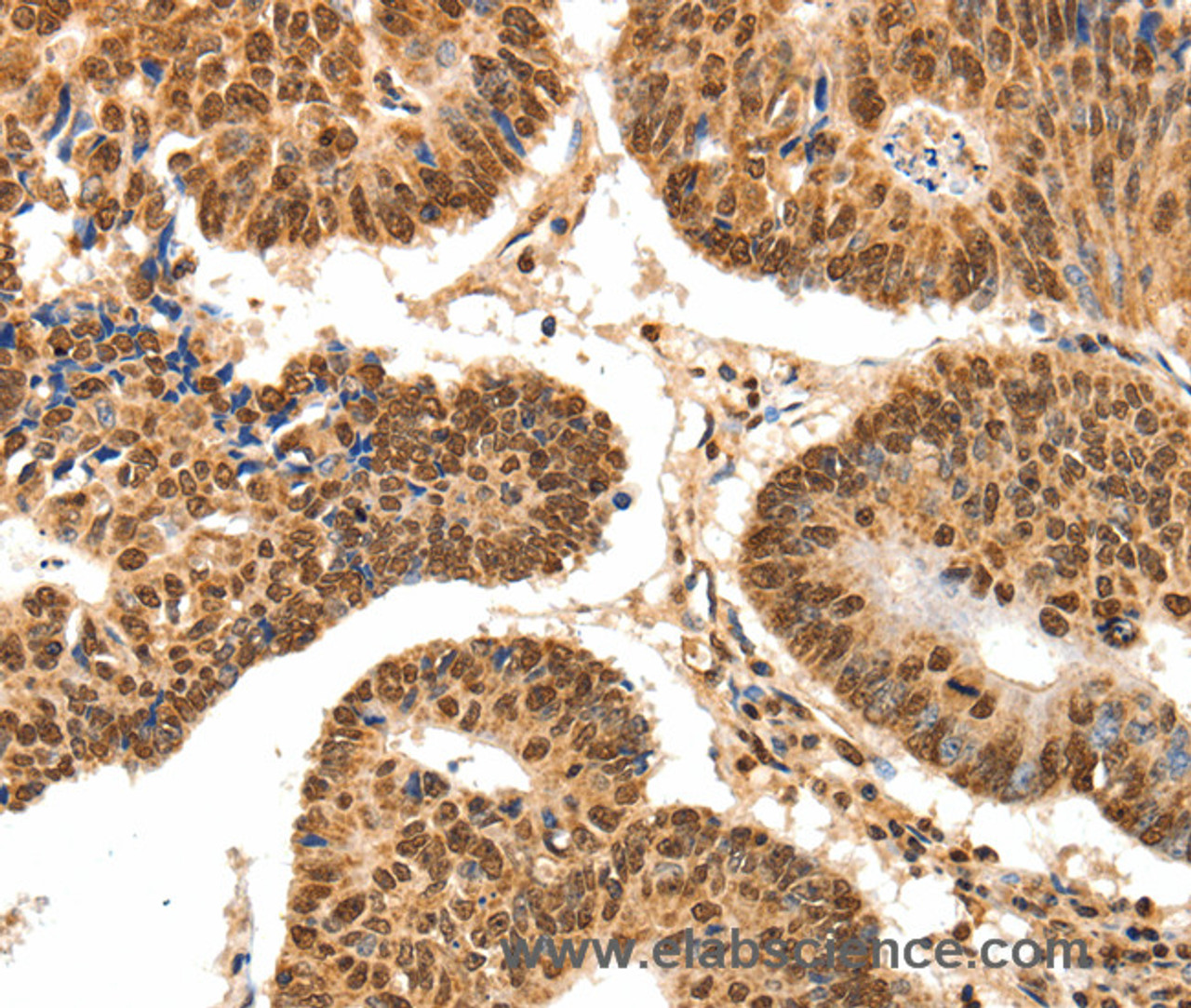 Immunohistochemistry of paraffin-embedded Human colon cancer tissue using SPATA20 Polyclonal Antibody at dilution 1:70