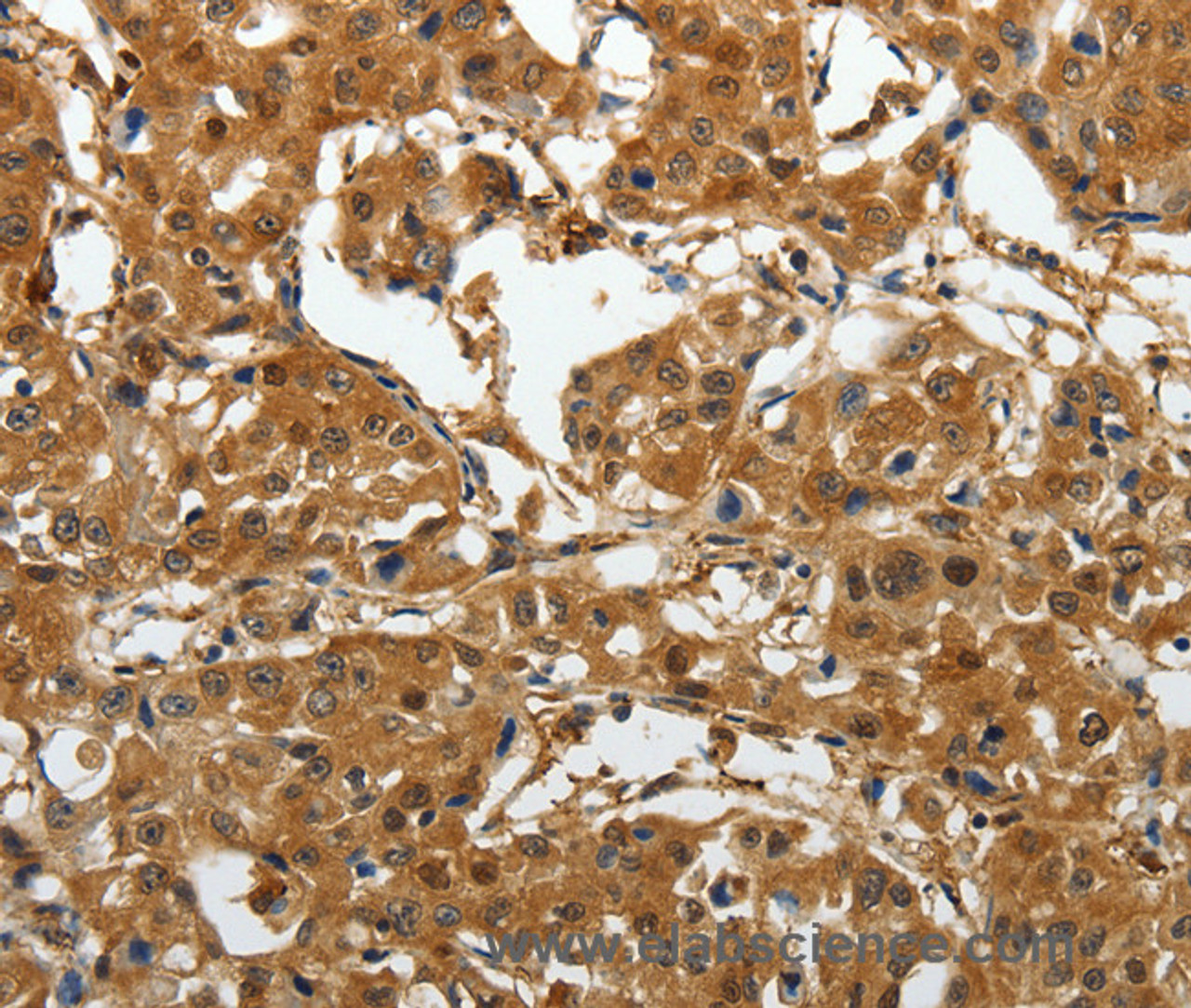 Immunohistochemistry of paraffin-embedded Human lung cancer tissue using AKAP12 Polyclonal Antibody at dilution 1:40