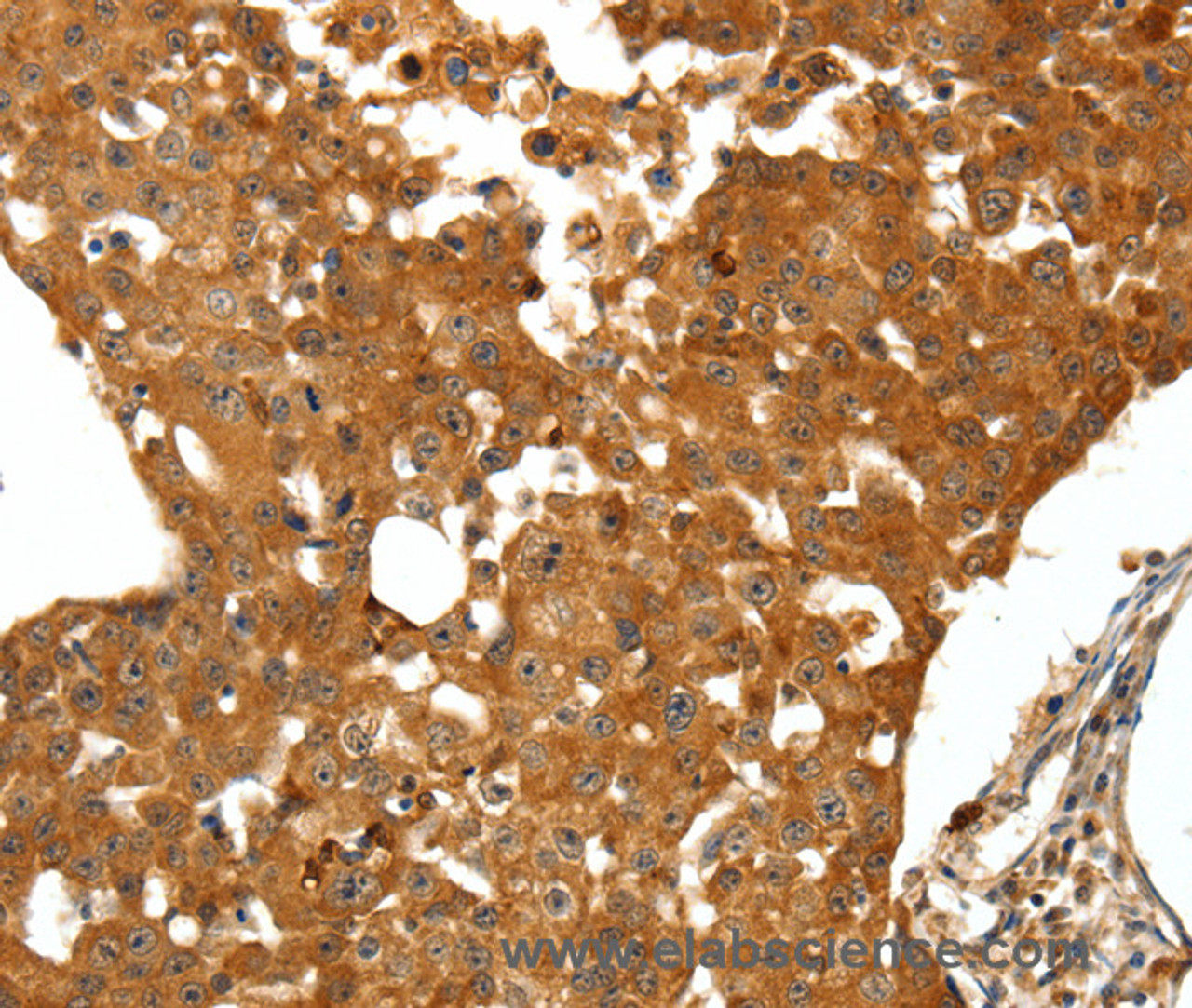 Immunohistochemistry of paraffin-embedded Human breast cancer tissue using SSTR1 Polyclonal Antibody at dilution 1:50