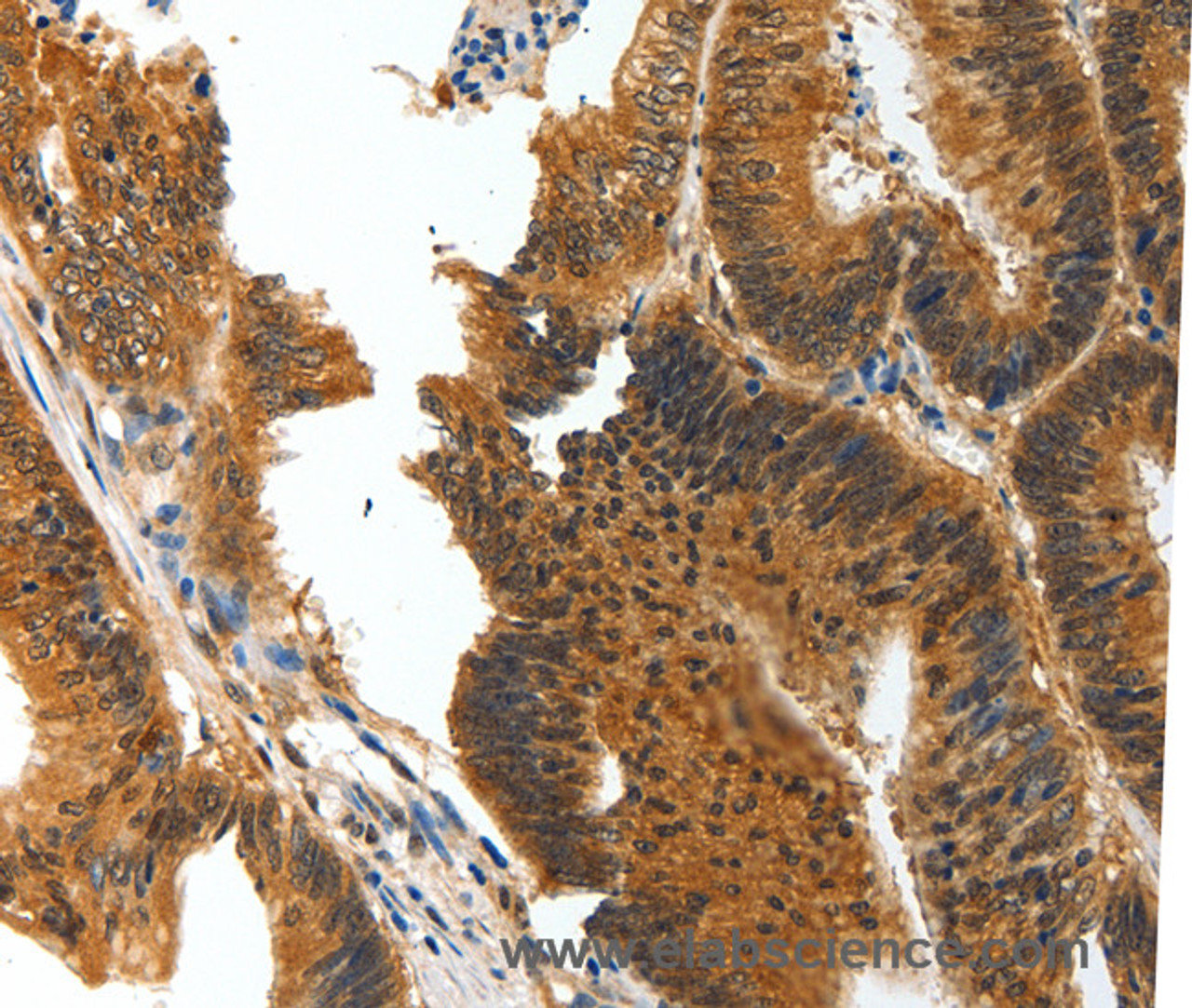 Immunohistochemistry of paraffin-embedded Human colon cancer tissue using BIRC6 Polyclonal Antibody at dilution 1:30