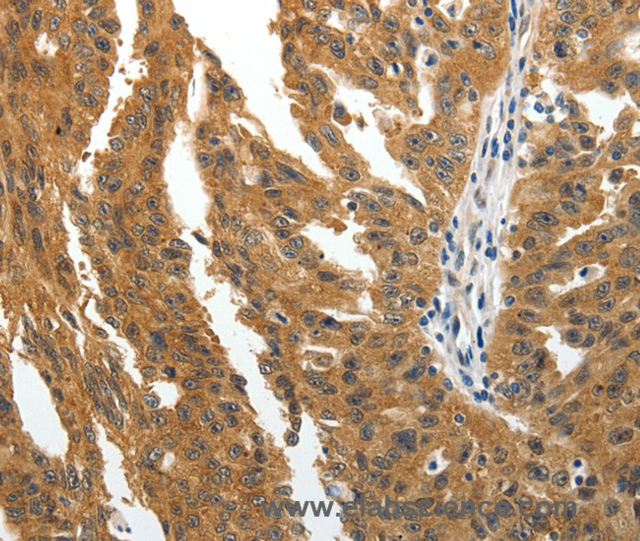 Immunohistochemistry of paraffin-embedded Human ovarian cancer tissue using BIRC6 Polyclonal Antibody at dilution 1:30