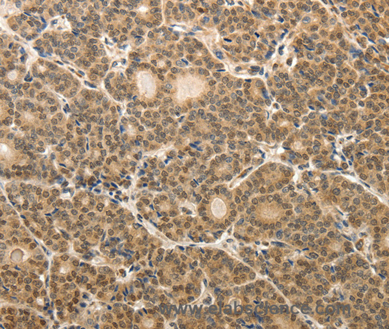 Immunohistochemistry of paraffin-embedded Human thyroid cancer tissue using MAP1A Polyclonal Antibody at dilution 1:40