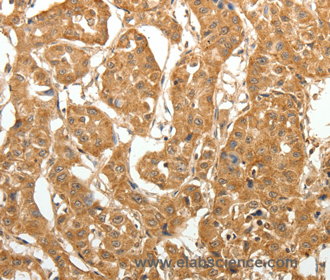 Immunohistochemistry of paraffin-embedded Human lung cancer tissue using MAP1B  Polyclonal Antibody at dilution 1:60