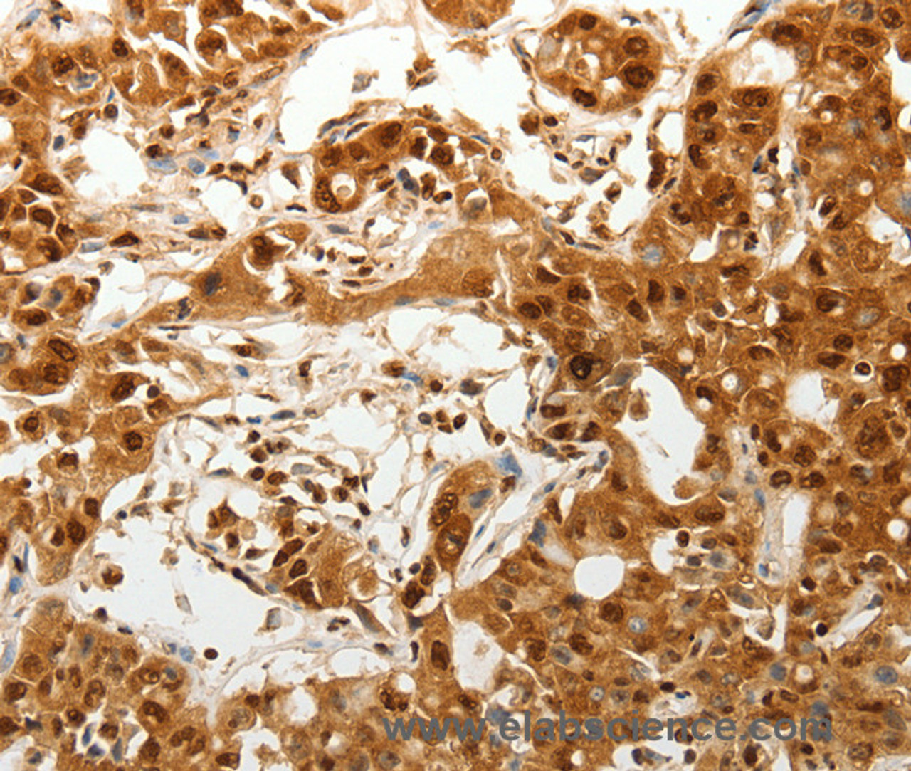 Immunohistochemistry of paraffin-embedded Human ovarian cancer tissue using TENM3 Polyclonal Antibody at dilution 1:50